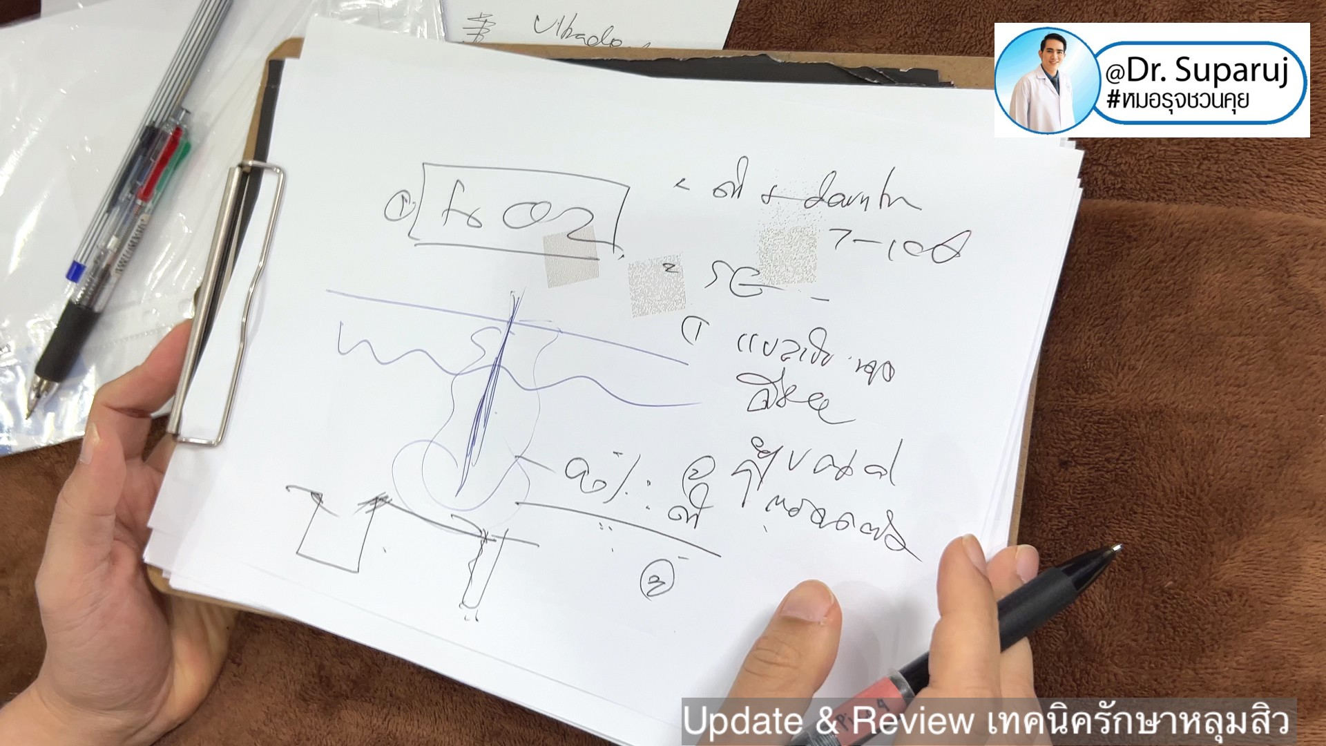 Update & Review เทคนิครักษาหลุมสิว (Acne Scar Treatment: Update & Review) Update & Review เทคนิครักษาหลุมสิว (Acne Scar Treatment: Update & Review)