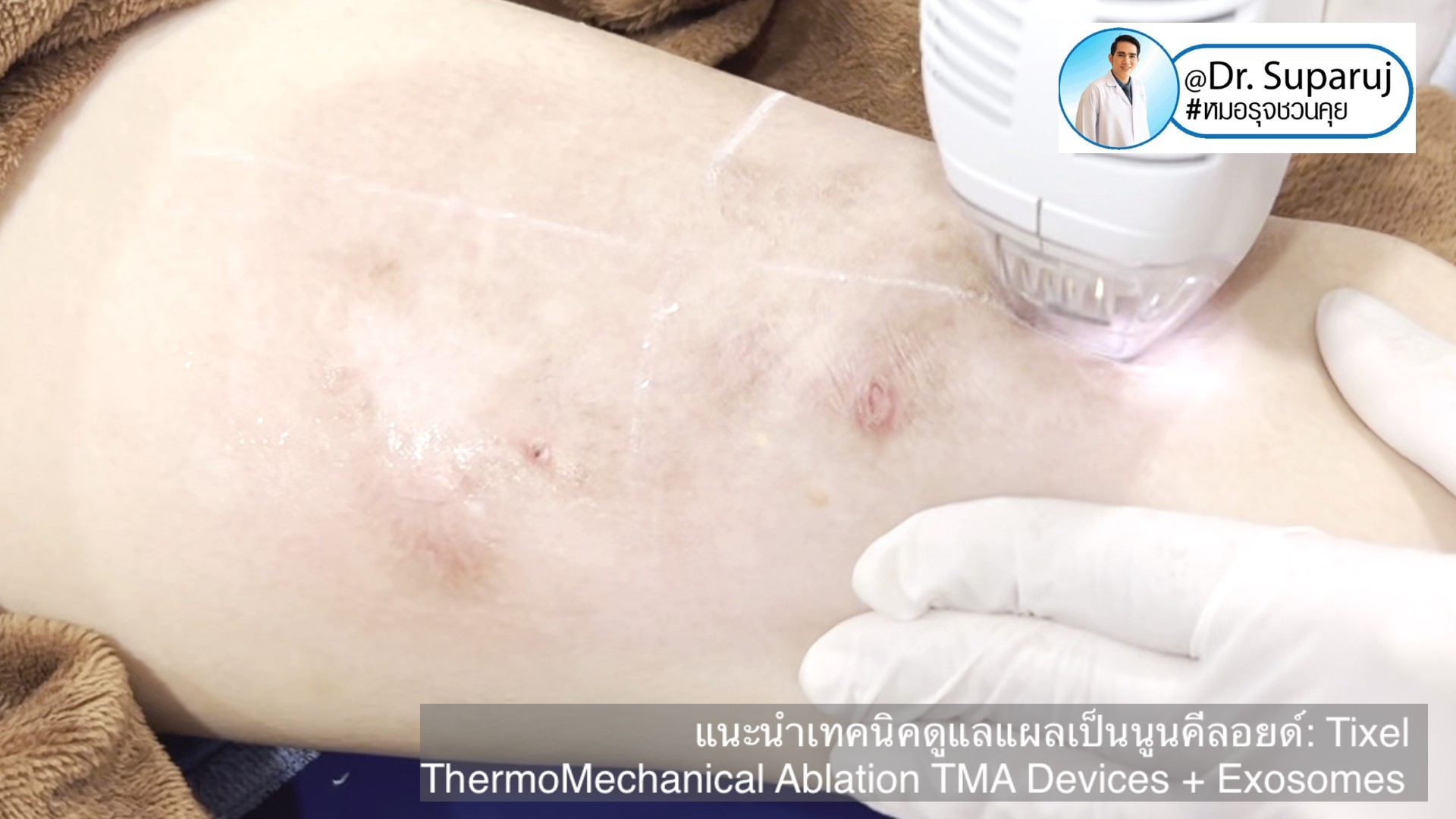 แนะนำเทคนิคดูแลแผลเป็นนูนคีลอยด์: รักษาแผลเป็นนูนด้วยทิกเซลล์ Tixel Fractional ThermoMechanical Ablation Devices + Exosomes แนะนำเทคนิคดูแลแผลเป็นนูนคีลอยด์: รักษาแผลเป็นนูนด้วยทิกเซลล์ Tixel Fractional ThermoMechanical Ablation Devices + Exosomes