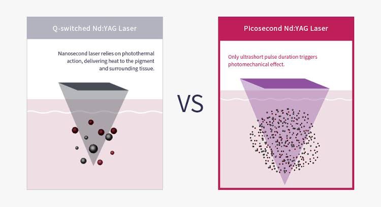 เทคนิครักษากระโฮริ กระลึก ปานโฮริ (Hori's nevus) ด้วยเลเซอร์ Discovery Picosecond Laser เทคนิครักษากระโฮริ กระลึก ปานโฮริ (Hori's nevus) ด้วยเลเซอร์ Discovery Picosecond Laser