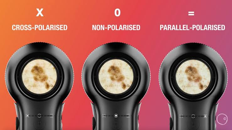 Update เทคนิคดูแลปัญหาผิวหนัง:กล้องส่องขยายพิเศษทางผิวหนัง Dermlite DL5 Dermopcopy Update เทคนิคดูแลปัญหาผิวหนัง:กล้องส่องขยายพิเศษทางผิวหนัง Dermlite DL5 Dermopcopy