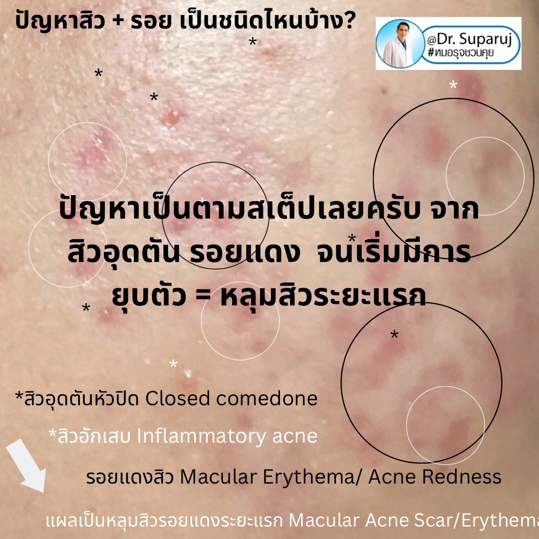 ปัญหาสิว + รอย เป็นชนิดไหนบ้าง? ปัญหาสิว + รอย เป็นชนิดไหนบ้าง?