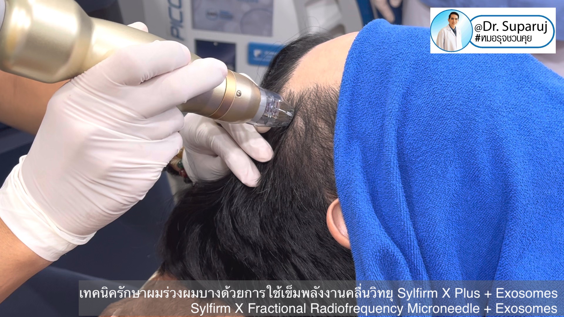 แนะนำเทคนิคดูแลผมร่วงผมบางด้วย Sylfirm X Fractional RF Microneedle + Exosomes for Hair Loss Treatment แนะนำเทคนิคดูแลผมร่วงผมบางด้วย Sylfirm X Fractional RF Microneedle + Exosomes for Hair Loss Treatment