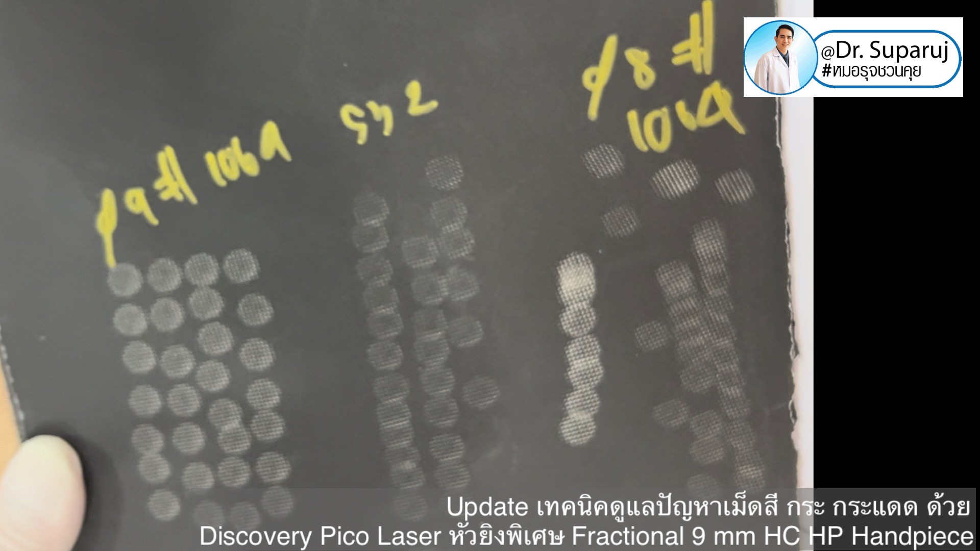Update เทคนิคดูแลปัญหาเม็ดสี กระ กระแดด ด้วย Discovery Pico Laser หัวยิงเลเซอร์พิเศษ Fractional 9 mm HC HP Handpiece Update เทคนิคดูแลปัญหาเม็ดสี กระ กระแดด ด้วย Discovery Pico Laser หัวยิงเลเซอร์พิเศษ Fractional 9 mm HC HP Handpiece