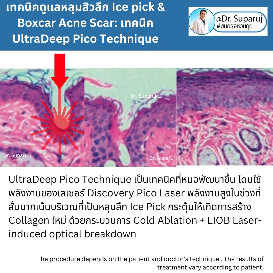 แนะนำเทคนิคดูแลหลุมสิวลึก Ice pick & Boxcar Acne Scar: เทคนิค UltraDeep Pico Technique