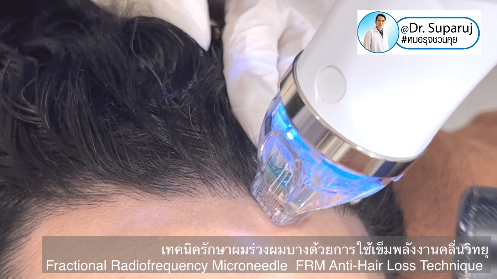 แนะนำเทคนิครักษาผมร่วงผมบาง: เทคนิครักษาผมร่วงผมบางด้วยการใช้เข็มพลังงานคลื่นวิทยุ Fractional Radiofrequency Microneedle FRM Anti-Hair Loss Technique แนะนำเทคนิครักษาผมร่วงผมบาง: เทคนิครักษาผมร่วงผมบางด้วยการใช้เข็มพลังงานคลื่นวิทยุ Fractional Radiofrequency Microneedle FRM Anti-Hair Loss Technique