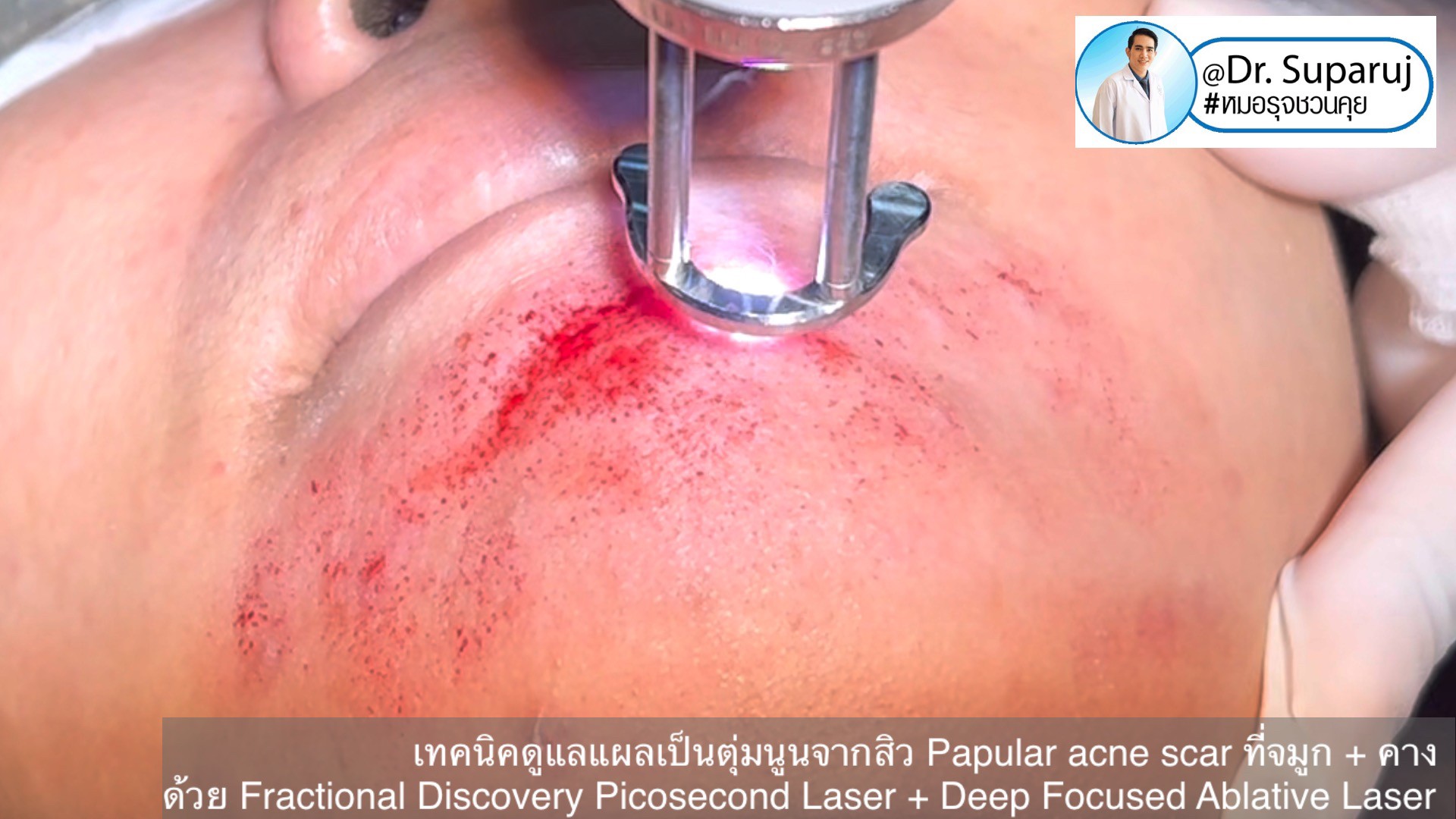 เทคนิคดูแลแผลเป็นตุ่มนูนจากสิว Papular acne scar ที่จมูก + คาง ด้วย Fractional Discovery Picosecond Laser + Deep Focused Ablative Laser เทคนิคดูแลแผลเป็นตุ่มนูนจากสิว Papular acne scar ที่จมูก + คาง ด้วย Fractional Discovery Picosecond Laser + Deep Focused Ablative Laser