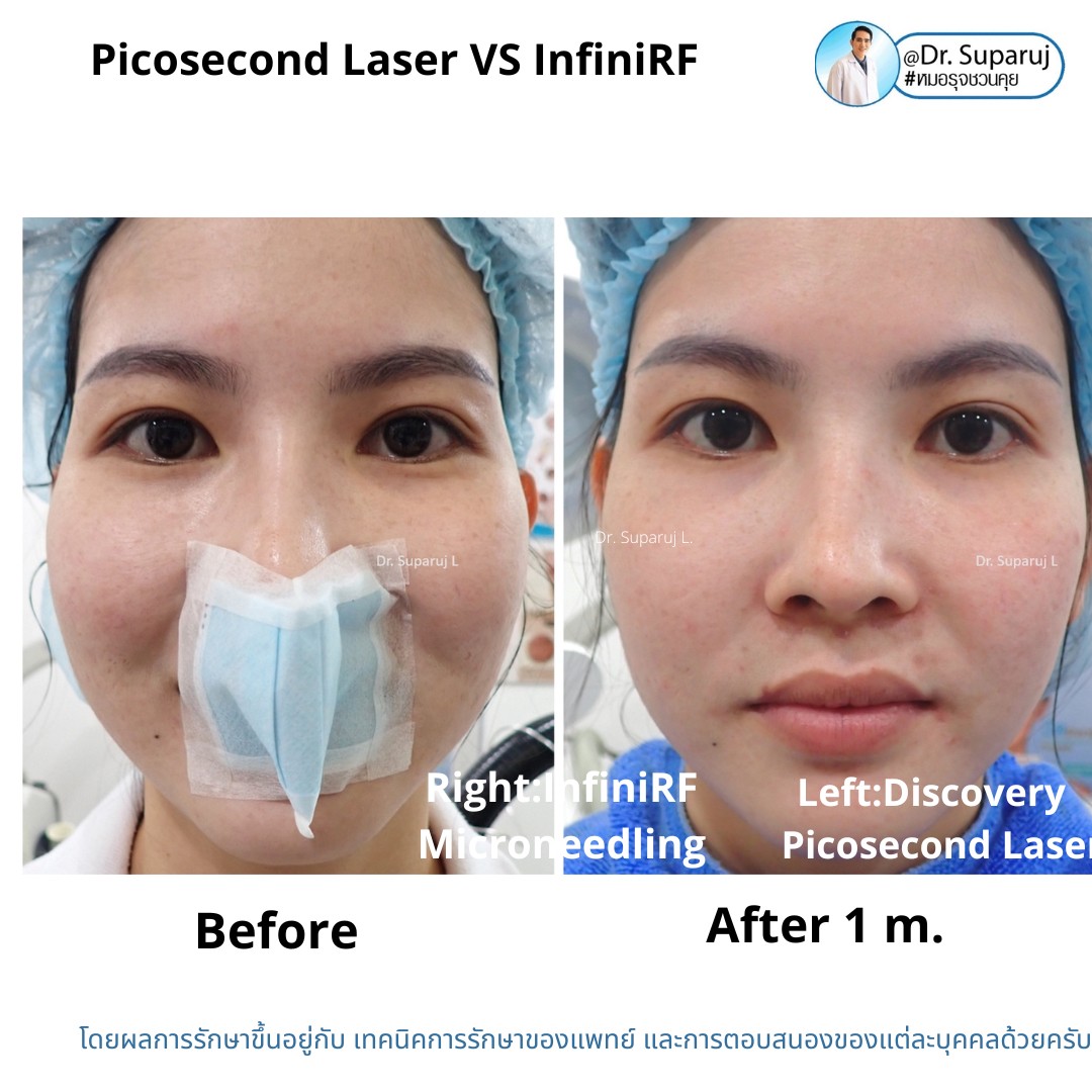 แนะนำเทคนิครักษาหลุมสิว: ดูแลหลุมสิวด้วยเข็มพลังงานคลื่นวิทยุ Infini RF Microneedle แนะนำเทคนิครักษาหลุมสิว: ดูแลหลุมสิวด้วยเข็มพลังงานคลื่นวิทยุ Infini RF Microneedle