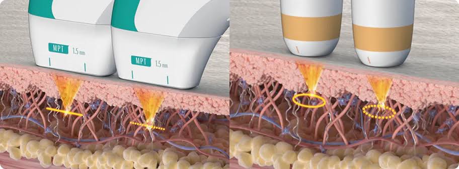 แนะนำนวัตกรรมยกกระชับผิวด้วยพลังงานคลื่นเสียง Hyperthermia Lifting Therapy: Ultraformer MPT Micro-Pulse Technology