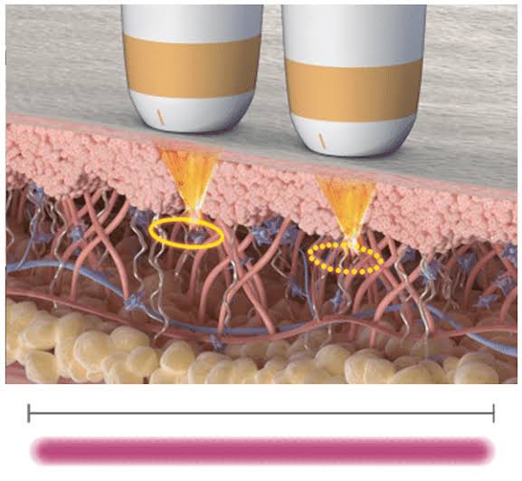 แนะนำนวัตกรรมยกกระชับผิวด้วยพลังงานคลื่นเสียง Hyperthermia Lifting Therapy: Ultraformer MPT Micro-Pulse Technology