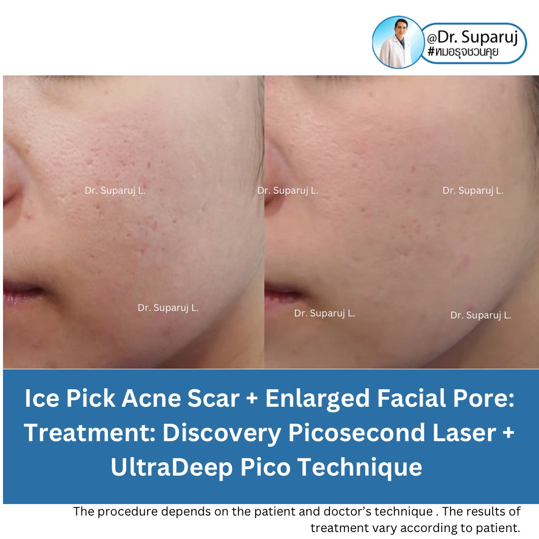 แนะนำเทคนิคดูแลหลุมสิวลึก Ice pick & Boxcar Acne Scar: เทคนิค UltraDeep Pico Technique แนะนำเทคนิคดูแลหลุมสิวลึก Ice pick & Boxcar Acne Scar: เทคนิค UltraDeep Pico Technique