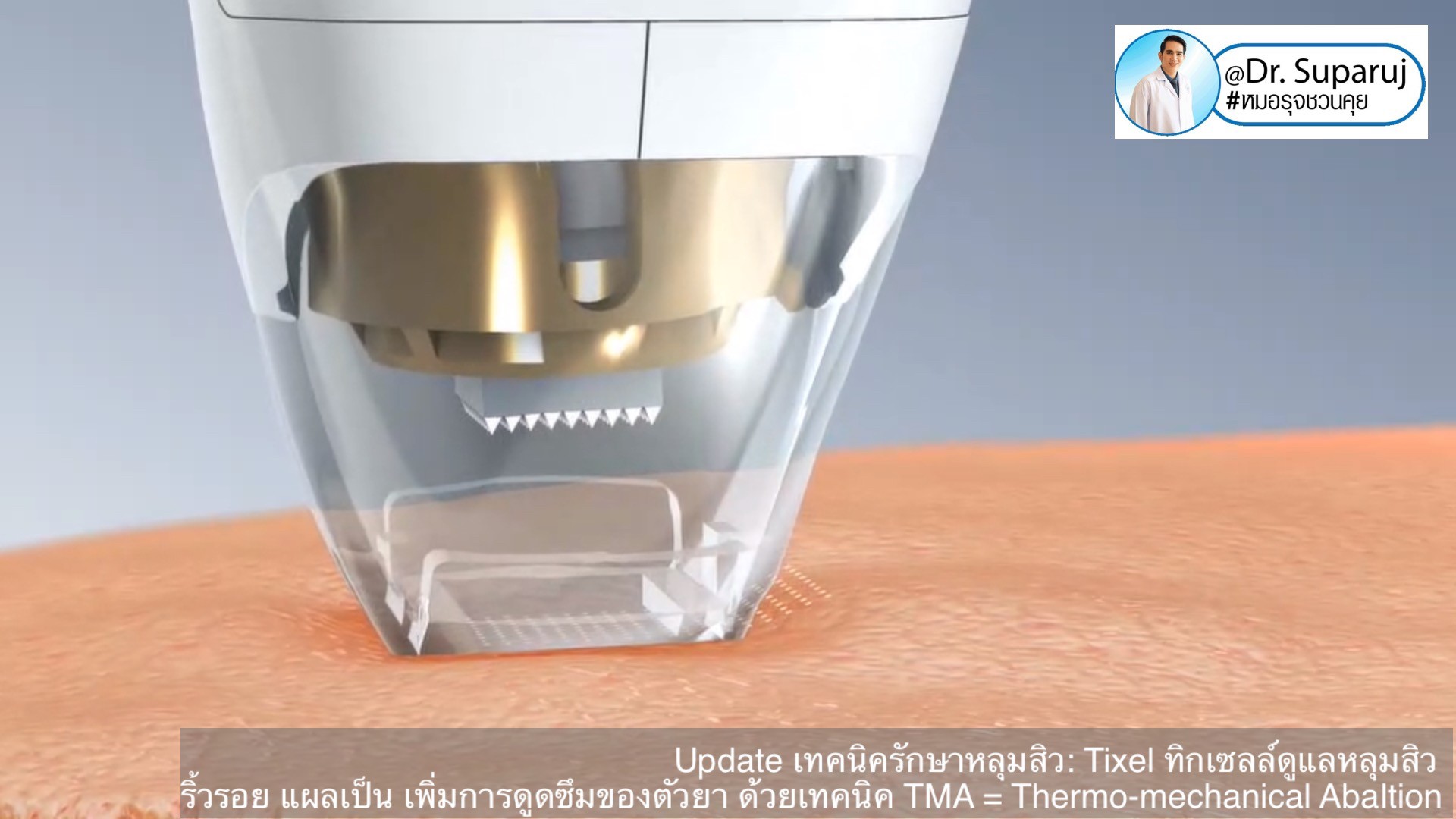 Update เทคนิครักษาหลุมสิว: Tixel ทิ๊กเซลล์ รักษาหลุมสิว ริ้วรอย แผลเป็น เพิ่มการดูดซึมยาด้วยเทคนิค TMA = Thermo-mechanical Abaltion Update เทคนิครักษาหลุมสิว: Tixel ทิ๊กเซลล์ รักษาหลุมสิว ริ้วรอย แผลเป็น เพิ่มการดูดซึมยาด้วยเทคนิค TMA = Thermo-mechanical Abaltion