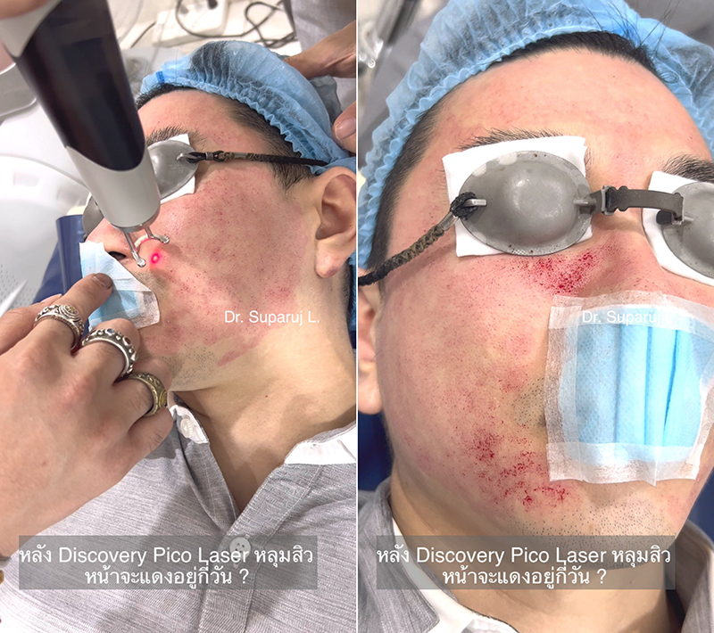 Q:Picosecond Laser หลุมสิวต้องยิงให้เลือดสาดไหม? Q:Picosecond Laser หลุมสิวต้องยิงให้เลือดสาดไหม?