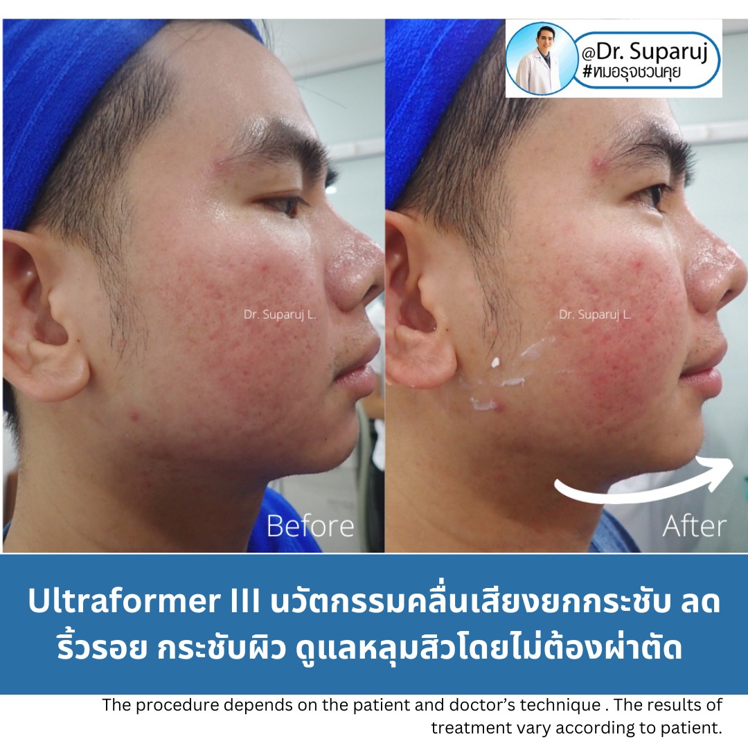 เทคโนโลยียกกระชับผิว MMFU : Micro &Macro Focused Ultrasound ของ Ultraformer III ทำงานอย่างไร ทำไมถึงดีกว่า HIFU ?