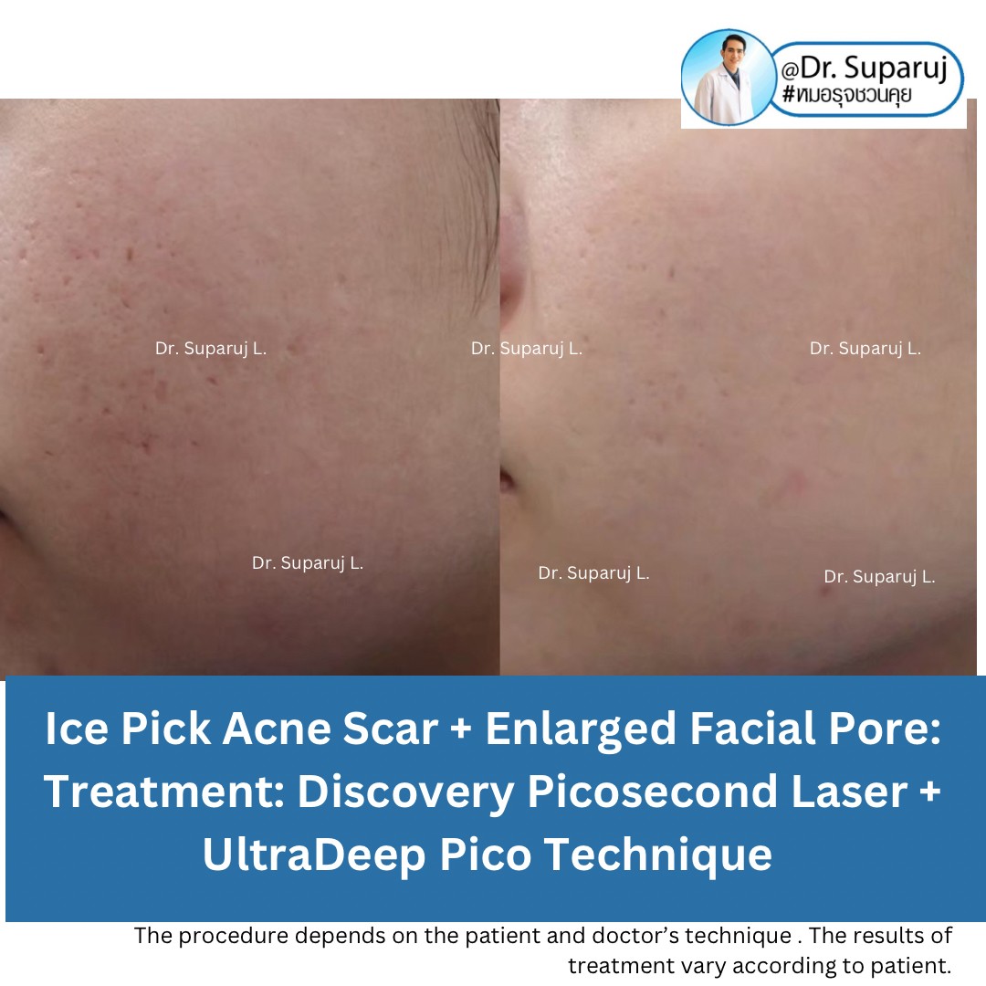 แนะนำเทคนิคดูแลหลุมสิวลึก Ice pick & Boxcar Acne Scar: เทคนิค UltraDeep Pico Technique