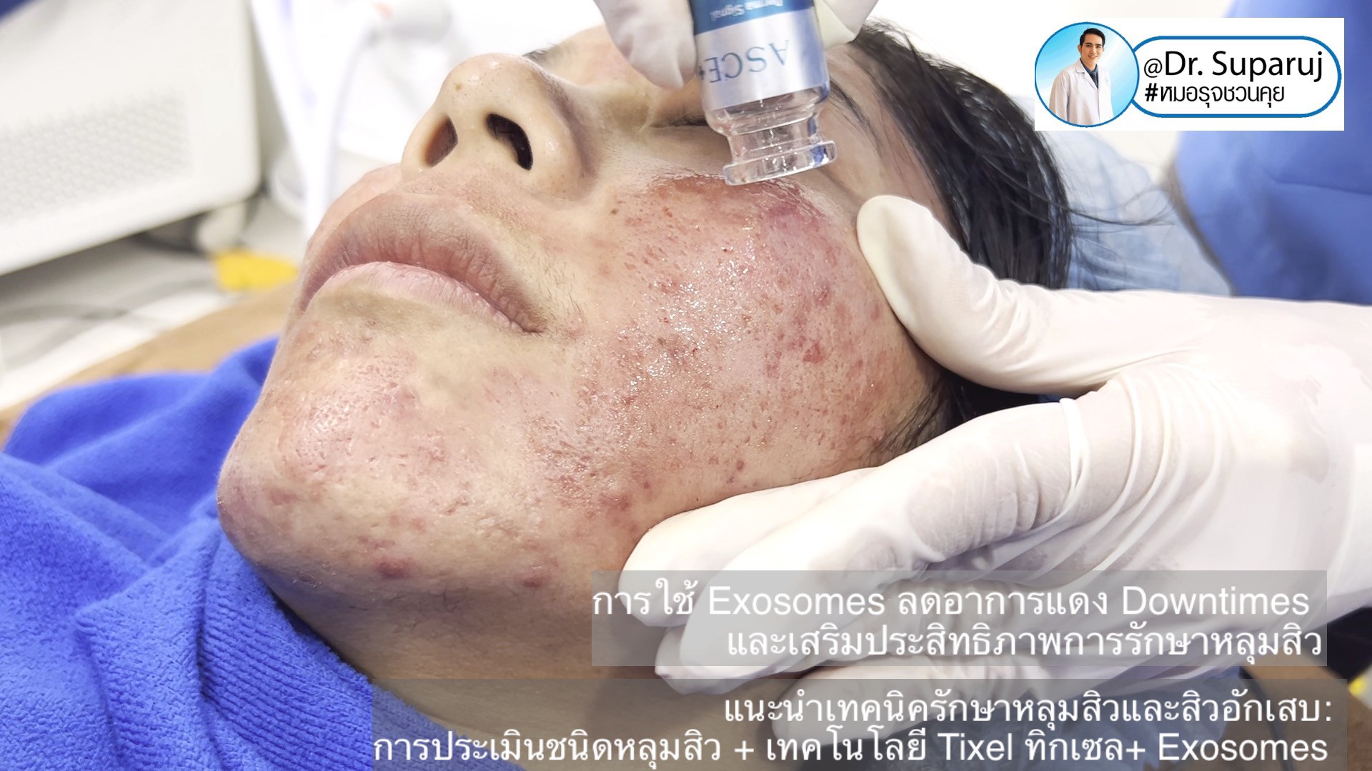 แนะนำเทคนิครักษาหลุมสิวและสิวอักเสบ: ประเมินชนิดความรุนแรงหลุมสิว + เทคโนโลยี Tixel ทิกเซล+ Exosomes แนะนำเทคนิครักษาหลุมสิวและสิวอักเสบ: ประเมินชนิดความรุนแรงหลุมสิว + เทคโนโลยี Tixel ทิกเซล+ Exosomes