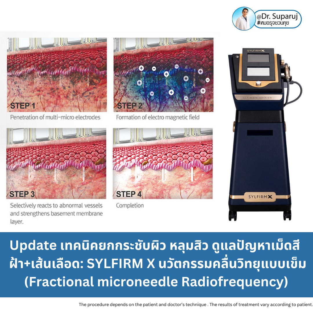 แนะนำเทคนิคดูแลแผลเป็นหลุมสิวด้วย SYLFIRM X Plus + Exosomes (SYLFIRM X Plus & Exosomes for Acne Scar Treatment) แนะนำเทคนิคดูแลแผลเป็นหลุมสิวด้วย SYLFIRM X Plus + Exosomes (SYLFIRM X Plus & Exosomes for Acne Scar Treatment)