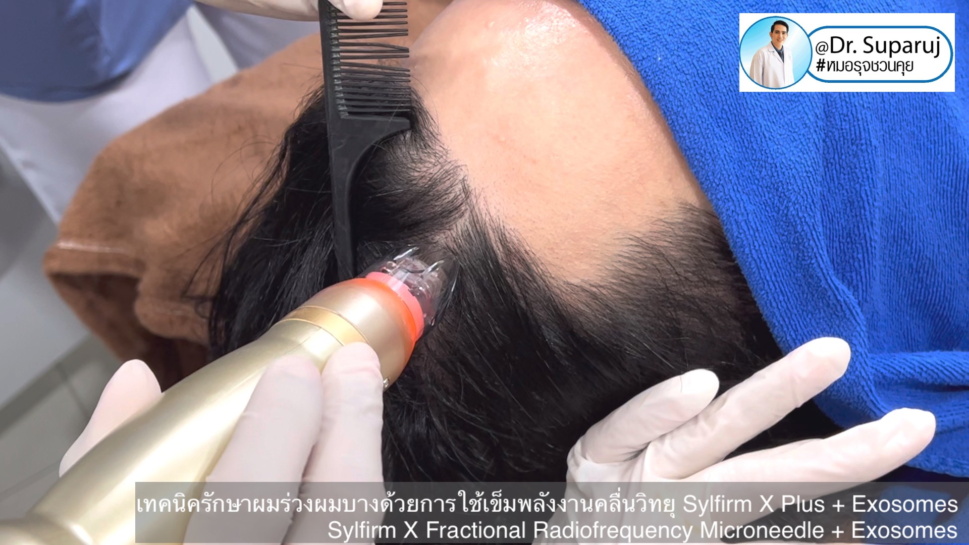 แนะนำ เทคนิครักษาผมร่วงผมบางด้วยการใช้เข็มพลังงานคลื่นวิทยุ Sylfirm X Plus + Exosomes (Sylfirm X Fractional Radiofrequency Microneedle + Exosomes) แนะนำ เทคนิครักษาผมร่วงผมบางด้วยการใช้เข็มพลังงานคลื่นวิทยุ Sylfirm X Plus + Exosomes (Sylfirm X Fractional Radiofrequency Microneedle + Exosomes)