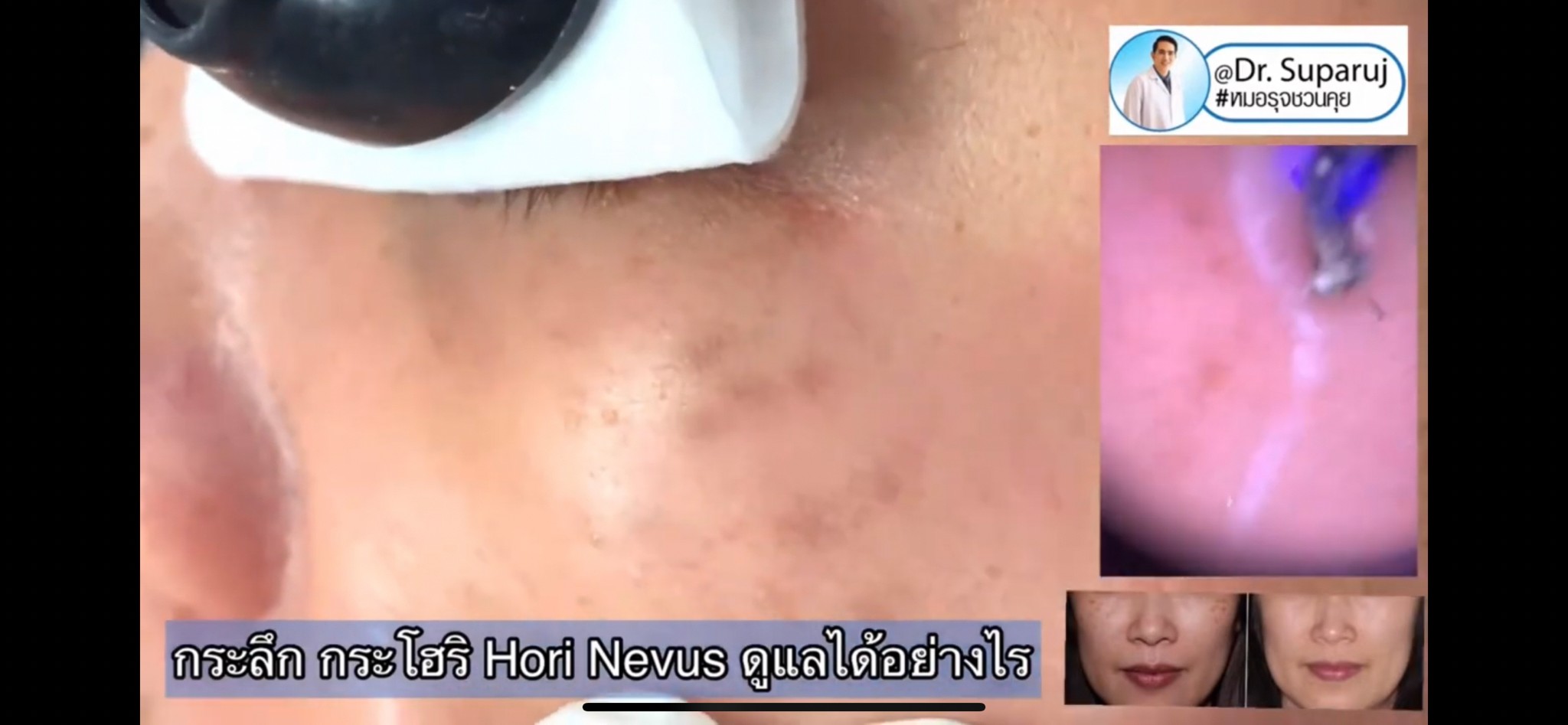 เทคนิครักษากระโฮริ กระลึก ปานโฮริ (Hori's nevus) ด้วยเลเซอร์ Discovery Picosecond Laser เทคนิครักษากระโฮริ กระลึก ปานโฮริ (Hori's nevus) ด้วยเลเซอร์ Discovery Picosecond Laser