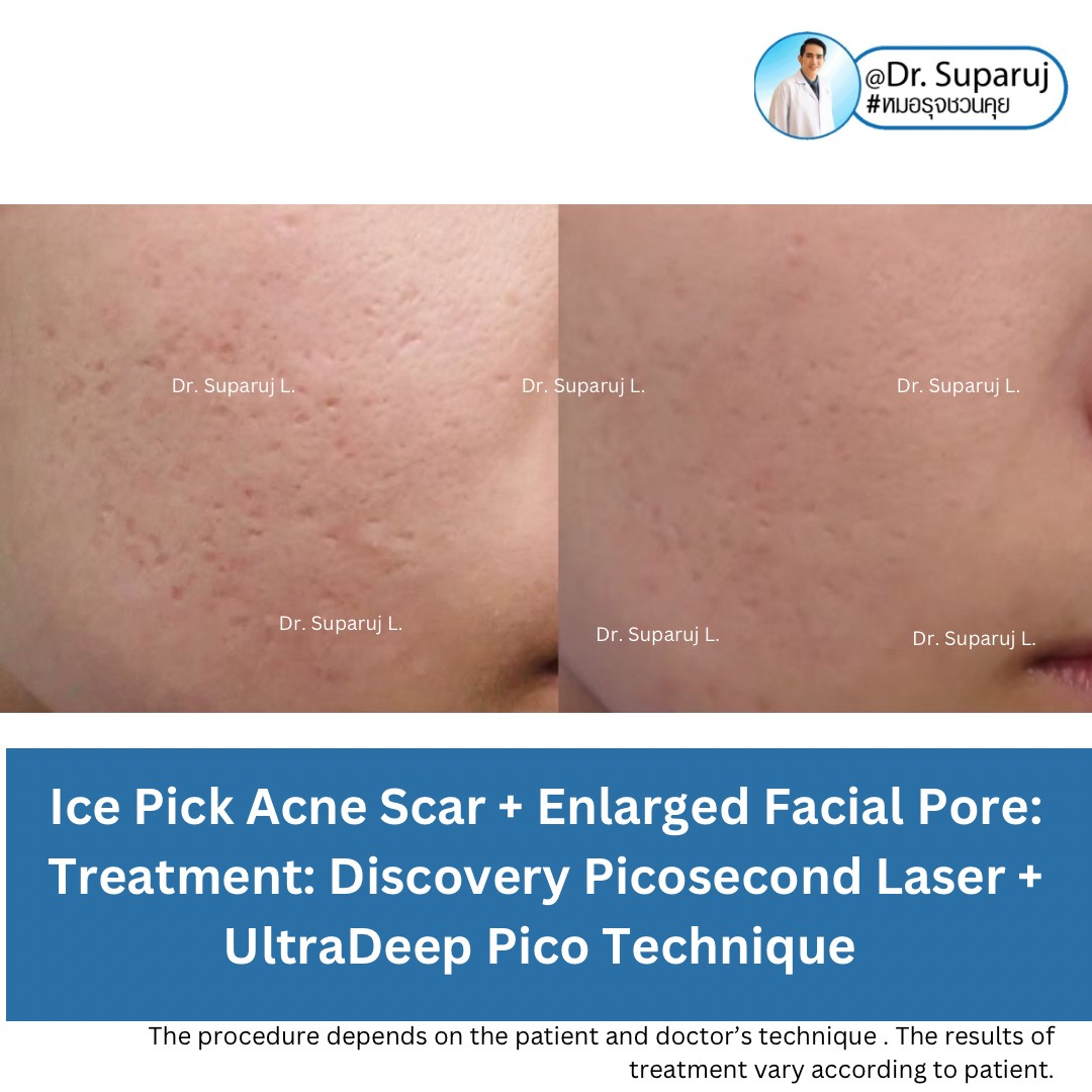 แนะนำเทคนิคดูแลหลุมสิวลึก Ice pick & Boxcar Acne Scar: เทคนิค UltraDeep Pico Technique