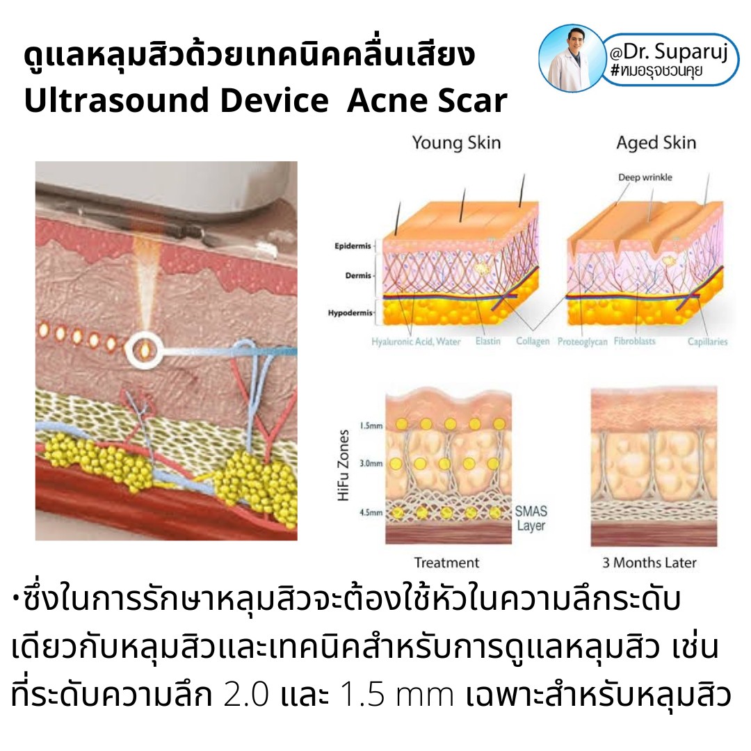 เทคโนโลยียกกระชับผิว MMFU : Micro &Macro Focused Ultrasound ของ Ultraformer III ทำงานอย่างไร ทำไมถึงดีกว่า HIFU ? เทคโนโลยียกกระชับผิว MMFU : Micro &Macro Focused Ultrasound ของ Ultraformer III ทำงานอย่างไร ทำไมถึงดีกว่า HIFU ?