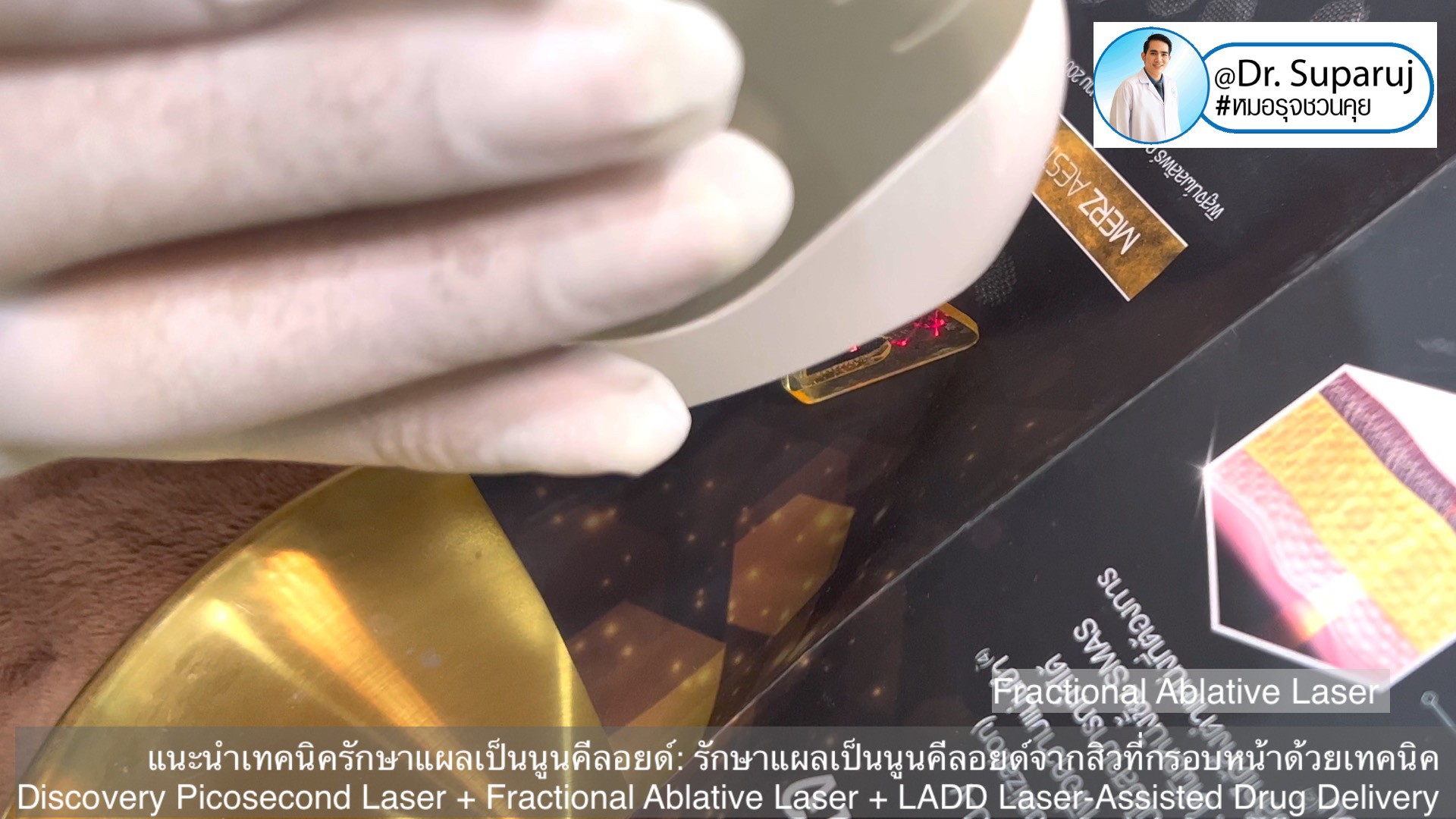 แนะนำเทคนิคดูแลแผลเป็นนูนคีลอยด์: รักษาแผลเป็นนูนคีลอยด์จากสิวที่กรอบหน้าด้วยเทคนิค Discovery Picosecond Laser + Fractional Ablative Laser + LADD Laser-Assisted Drug Delivery แนะนำเทคนิคดูแลแผลเป็นนูนคีลอยด์: รักษาแผลเป็นนูนคีลอยด์จากสิวที่กรอบหน้าด้วยเทคนิค Discovery Picosecond Laser + Fractional Ablative Laser + LADD Laser-Assisted Drug Delivery