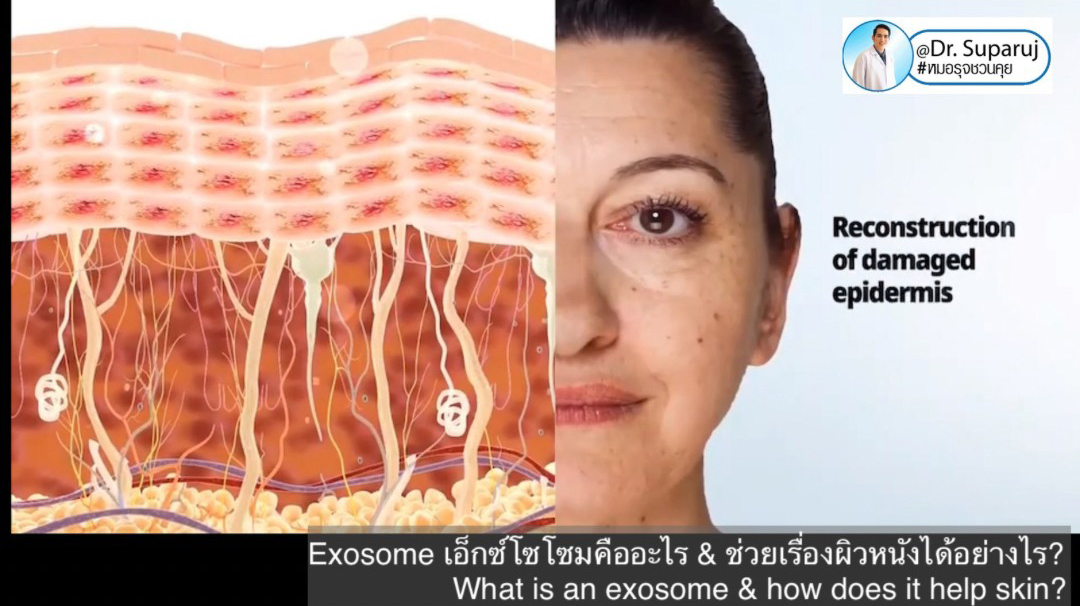 Exosomes มีบทบาทและกลไกในการดูแลฝ้า หรือไม่ & กลไกลเป็นอย่างไร ? Exosomes มีบทบาทและกลไกในการดูแลฝ้า หรือไม่ & กลไกลเป็นอย่างไร ?