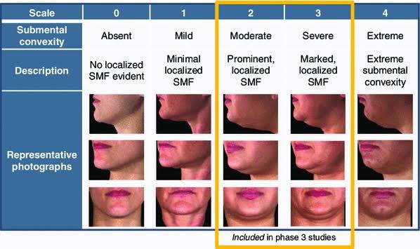 สาเหตุ & เทคนิคลดเหนียง ไขมันใต้คาง คาง 2 ชั้น Double Chin & Submental Fullness Treatment 