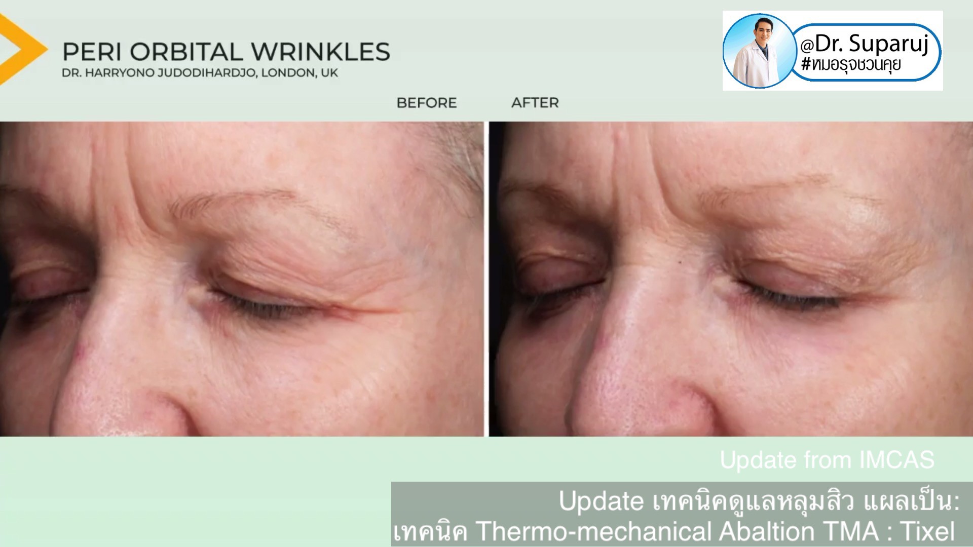 Update from IMCAS เทคนิครักษาหลุมสิว แผลเป็น ริ้วรอย: Tixel เทคนิค Thermo-mechanical Abaltion TMA Update from IMCAS เทคนิครักษาหลุมสิว แผลเป็น ริ้วรอย: Tixel เทคนิค Thermo-mechanical Abaltion TMA