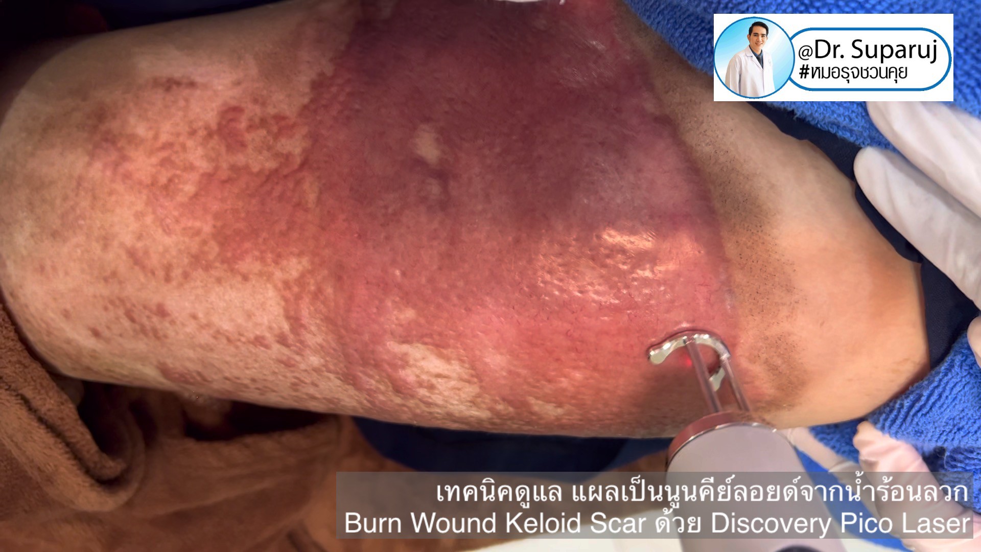 แนะนำเทคนิคดูแลแผลเป็น: เทคนิคดูแล แผลเป็นนูนคีย์ลอยด์จากน้ำร้อนลวก Burn Wound Keloid Scar ด้วย Discovery Pico Laser แนะนำเทคนิคดูแลแผลเป็น: เทคนิคดูแล แผลเป็นนูนคีย์ลอยด์จากน้ำร้อนลวก Burn Wound Keloid Scar ด้วย Discovery Pico Laser