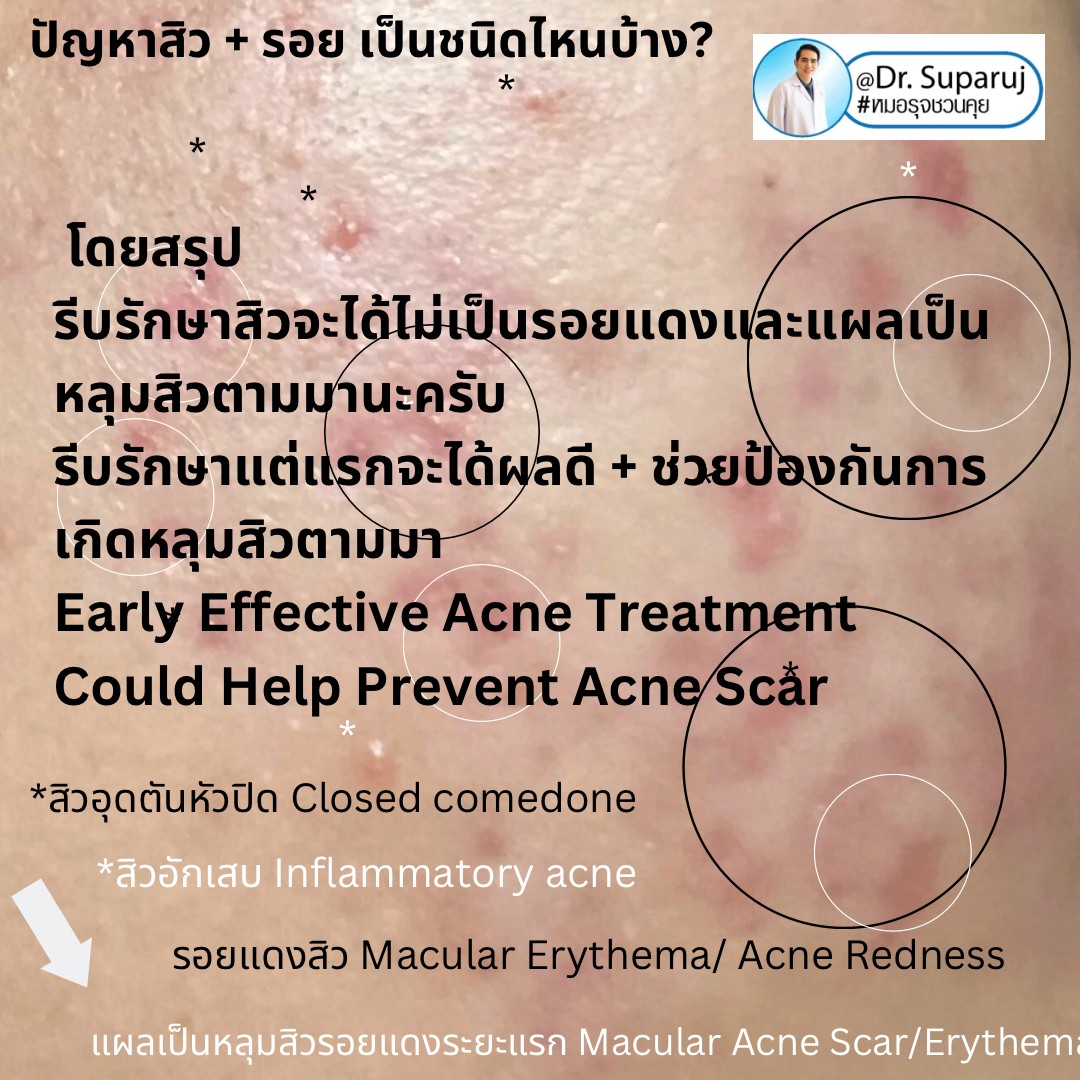 ปัญหาสิว + รอย เป็นชนิดไหนบ้าง? ปัญหาสิว + รอย เป็นชนิดไหนบ้าง?