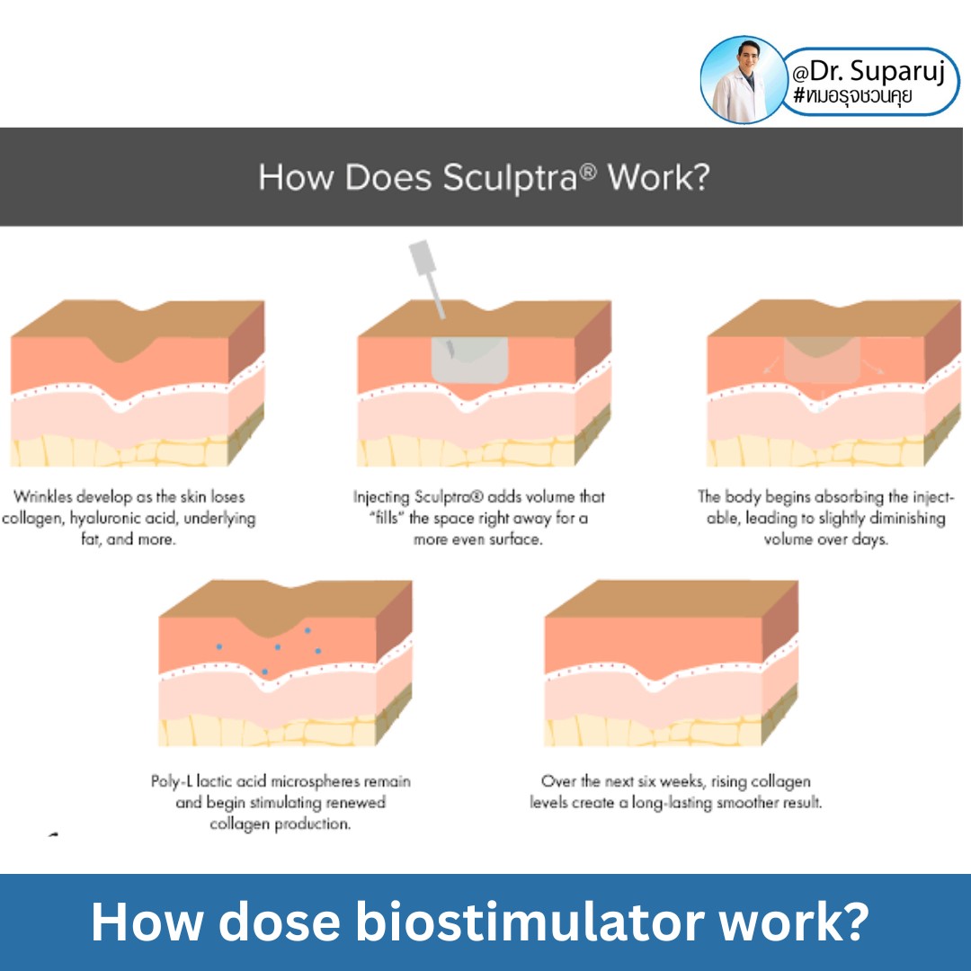 Update เทคนิคกระตุ้นการสร้างคอลลาเจนในผิวหนังลดเลือนริ้วรอย: Collagen Biostimulator Update เทคนิคกระตุ้นการสร้างคอลลาเจนในผิวหนังลดเลือนริ้วรอย: Collagen Biostimulator