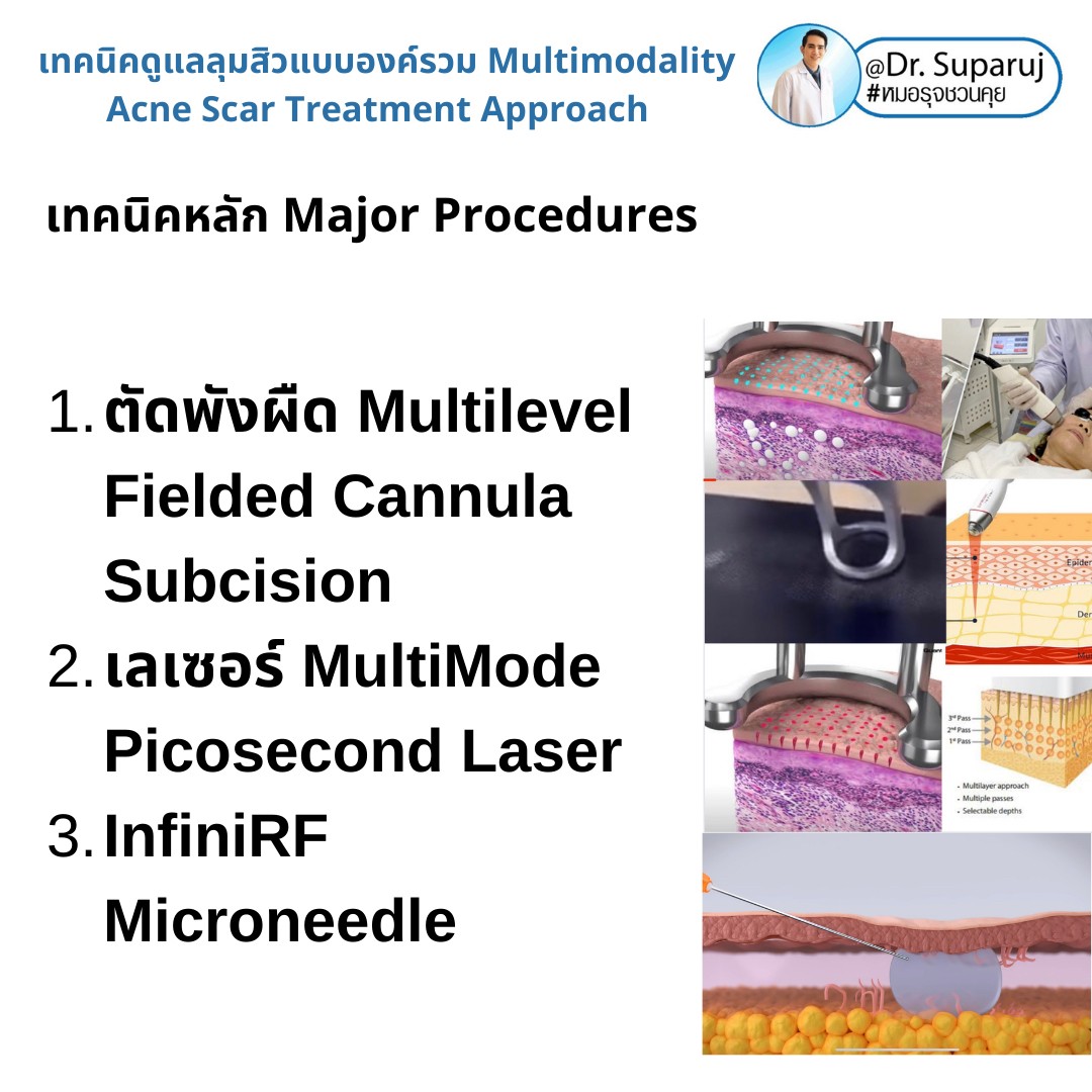 แนะนำเทคนิคดูแลหลุมสิว: เทคนิคการรักษาหลุมสิวชนิดไหนดีที่สุด? แนะนำเทคนิคดูแลหลุมสิว: เทคนิคการรักษาหลุมสิวชนิดไหนดีที่สุด?