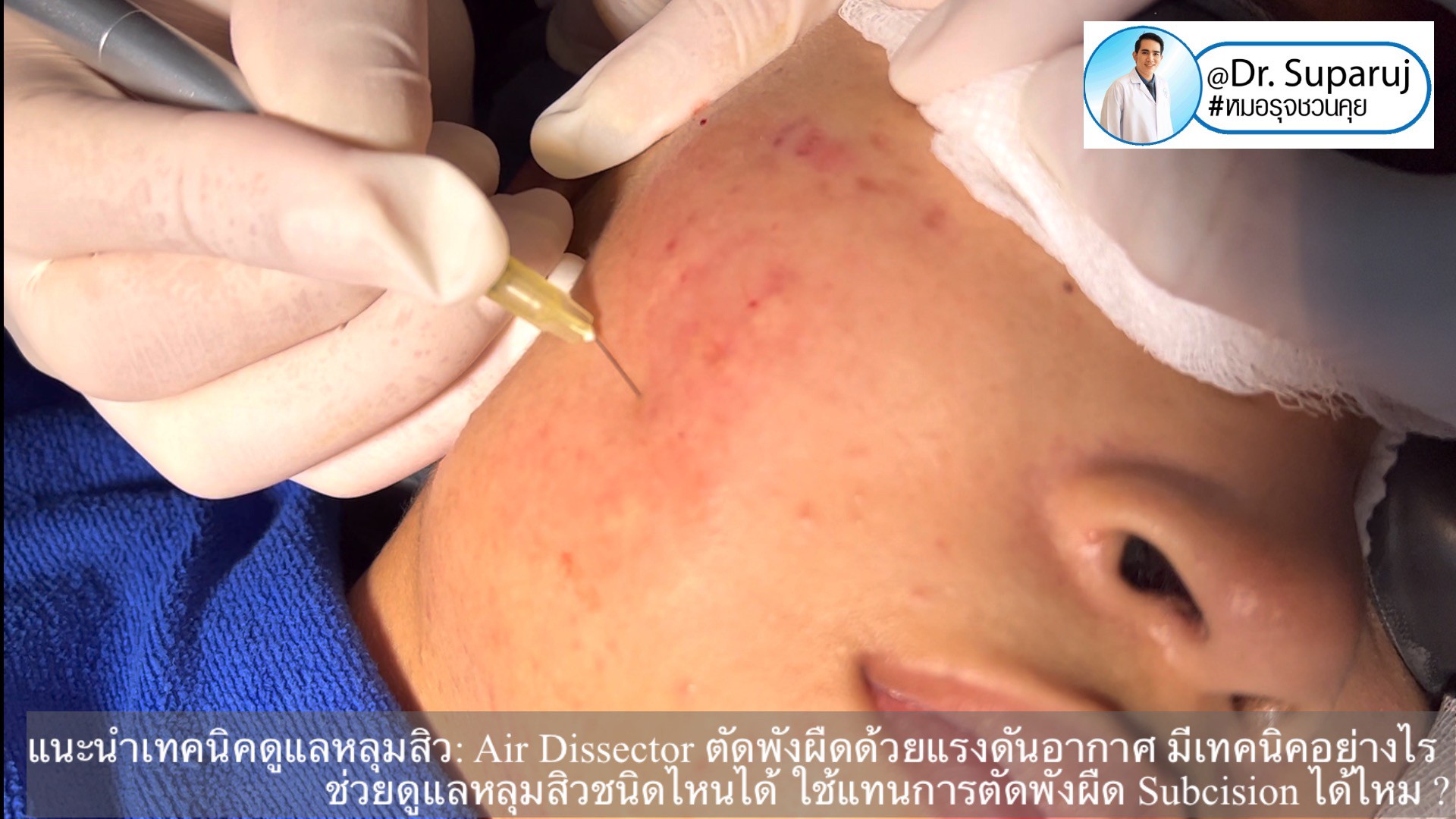 แนะนำเทคนิคดูแลหลุมสิว: Air Dissector ตัดพังผืดด้วยแรงดันอากาศ มีเทคนิคอย่างไร ช่วยดูแลหลุมสิวชนิดไหนได้ ใช้แทนการตัดพังผืด Subcision ได้ไหม ? แนะนำเทคนิคดูแลหลุมสิว: Air Dissector ตัดพังผืดด้วยแรงดันอากาศ มีเทคนิคอย่างไร ช่วยดูแลหลุมสิวชนิดไหนได้ ใช้แทนการตัดพังผืด Subcision ได้ไหม ?