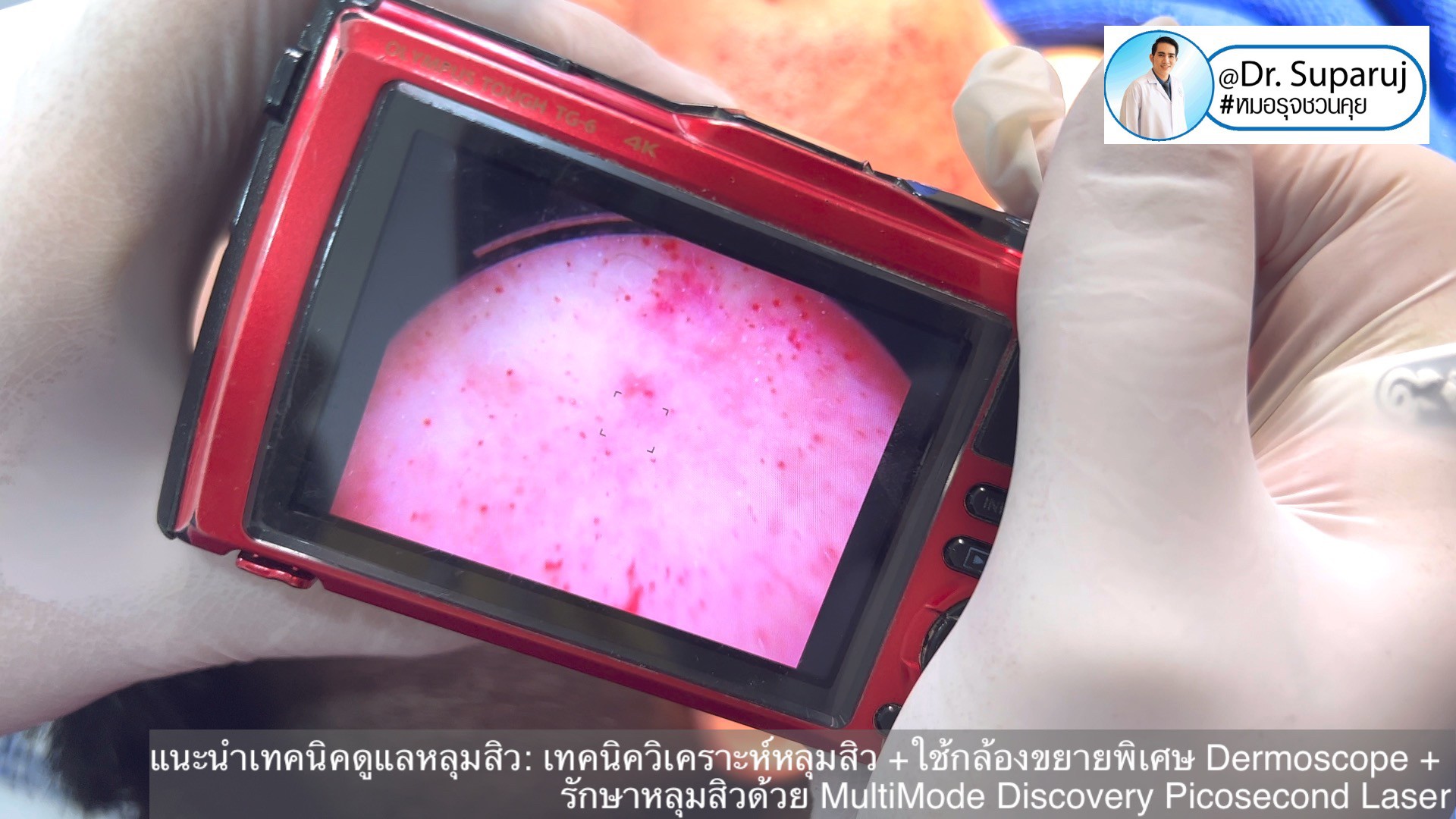 แนะนำเทคนิคดูแลหลุมสิว: เทคนิควิเคราะห์หลุมสิว +ใช้กล้องขยายพิเศษ Dermoscope + รักษาหลุมสิวด้วย MultiMode Discovery Picosecond Laser + Exosome Therapy แนะนำเทคนิคดูแลหลุมสิว: เทคนิควิเคราะห์หลุมสิว +ใช้กล้องขยายพิเศษ Dermoscope + รักษาหลุมสิวด้วย MultiMode Discovery Picosecond Laser + Exosome Therapy