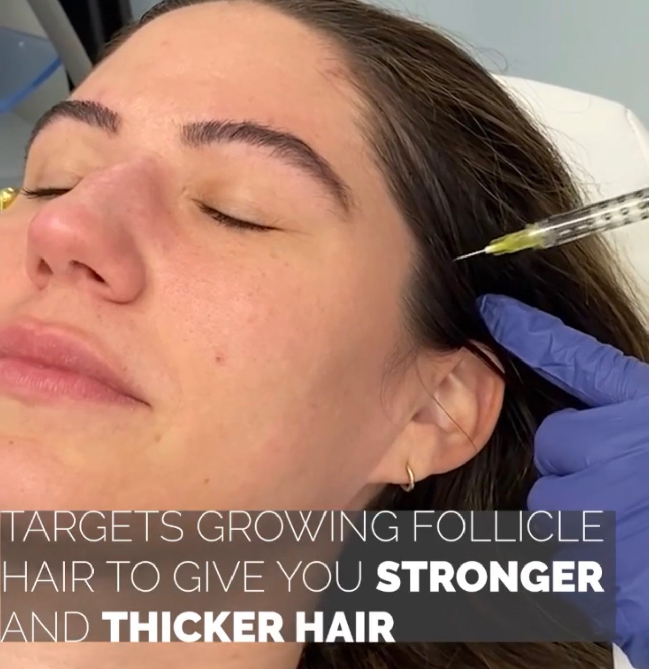 แนะนำเทคนิคดูแลปัญหาผมร่วงผมบาง: Exosome เอ็กโซโซม ช่วยดูแลผมร่วงผมบางได้อย่างไร? แนะนำเทคนิคดูแลปัญหาผมร่วงผมบาง: Exosome เอ็กโซโซม ช่วยดูแลผมร่วงผมบางได้อย่างไร?