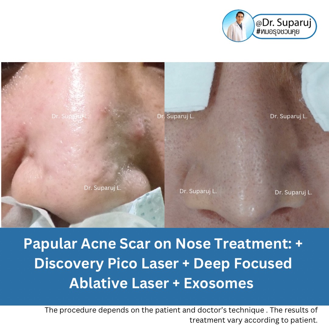 แนะนำเทคนิคดูแลรักษาหลุมสิว: เทคนิครักษาหลุมสิวด้วย 2 เทคนิคเสริมประสิทธิภาพ SYLFIRM X Plus + Discovery Pico Laser Combination Treatment แนะนำเทคนิคดูแลรักษาหลุมสิว: เทคนิครักษาหลุมสิวด้วย 2 เทคนิคเสริมประสิทธิภาพ SYLFIRM X Plus + Discovery Pico Laser Combination Treatment