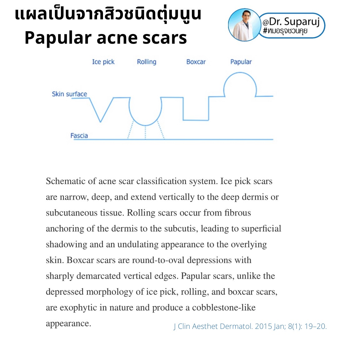 เทคนิคดูแลแผลเป็นตุ่มนูนจากสิว Papular acne scar ที่จมูก + คาง ด้วย Fractional Discovery Picosecond Laser + Deep Focused Ablative Laser