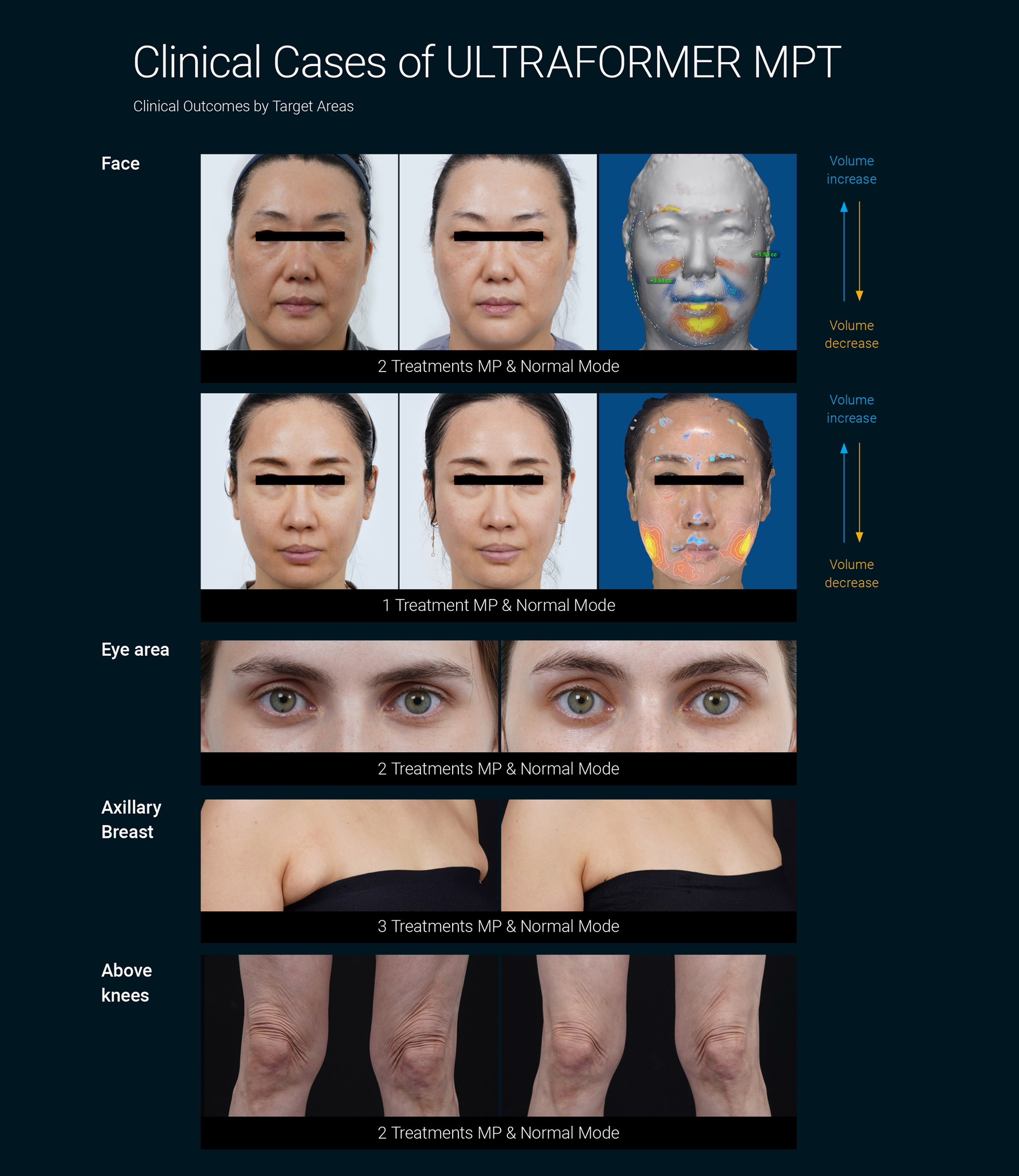 แนะนำนวัตกรรมยกกระชับผิวด้วยพลังงานคลื่นเสียง Hyperthermia Lifting Therapy: Ultraformer MPT Micro-Pulse Technology