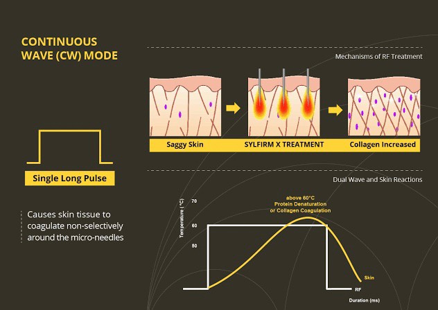 Update เทคนิคยกกระชับผิว หลุมสิว ดูแลปัญหาเม็ดสี ฝ้า+เส้นเลือด: SYLFIRM X นวัตกรรมคลื่นวิทยุแบบเข็ม (Fractional microneedle Radiofrequency) Update เทคนิคยกกระชับผิว หลุมสิว ดูแลปัญหาเม็ดสี ฝ้า+เส้นเลือด: SYLFIRM X นวัตกรรมคลื่นวิทยุแบบเข็ม (Fractional microneedle Radiofrequency)