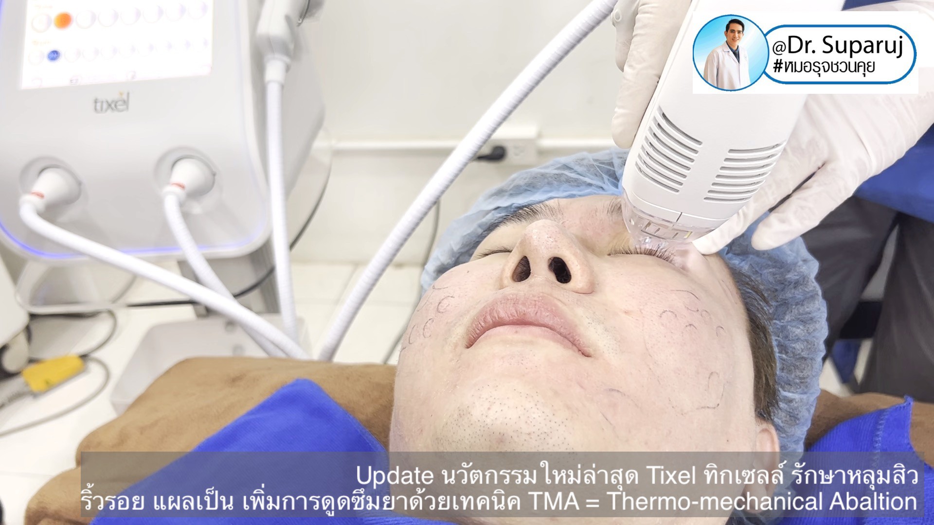 Update นวัตกรรมใหม่ล่าสุด Tixel ทิ๊กเซลล์ รักษาหลุมสิว ริ้วรอย แผลเป็น + Periorbital Tixel Treatment ดูแลริ้วรอยเปลือกตาและรอบดวงตาด้วยเทคนิค TMA = Thermo-mechanical Abaltion