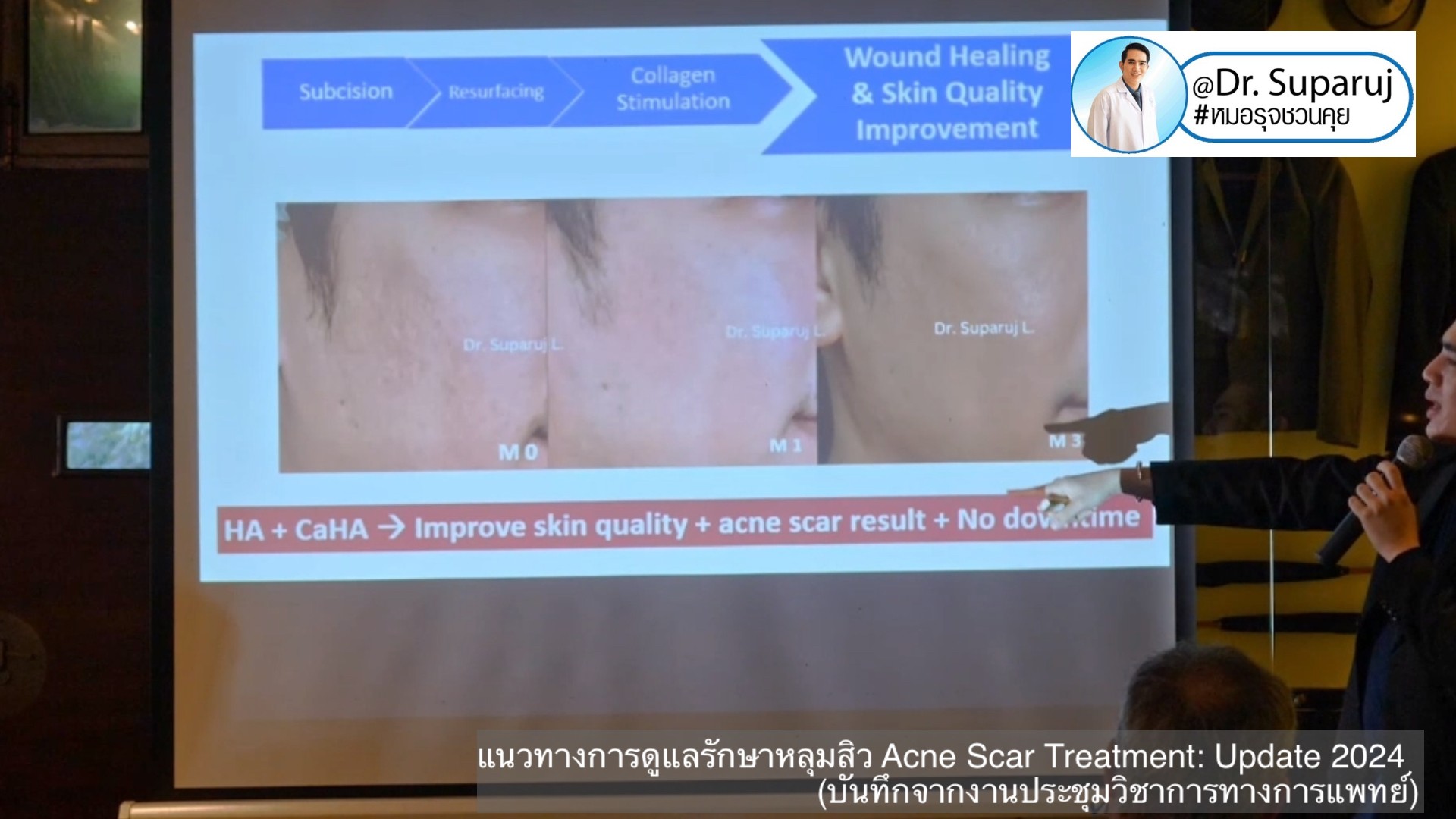 Update แนวทางการดูแลรักษาหลุมสิว Acne Scar Treatment: Update 2024 (บันทึกจากงานประชุมวิชาการทางการแพทย์ครับ) หมอมีบันทึกจากงานประชุมล่าสุดที่หมอได้รับเกียรติเป็นวิทยากรมาฝากกันครัข หมอได้สรุปเทคนิคการรักษาหลุมสิวต่างๆทั้งของเดิมและของใหม่มาฝากกัน อันนี้ตั Update แนวทางการดูแลรักษาหลุมสิว Acne Scar Treatment: Update 2024 (บันทึกจากงานประชุมวิชาการทางการแพทย์ครับ) หมอมีบันทึกจากงานประชุมล่าสุดที่หมอได้รับเกียรติเป็นวิทยากรมาฝากกันครัข หมอได้สรุปเทคนิคการรักษาหลุมสิวต่างๆทั้งของเดิมและของใหม่มาฝากกัน อันนี้ตั