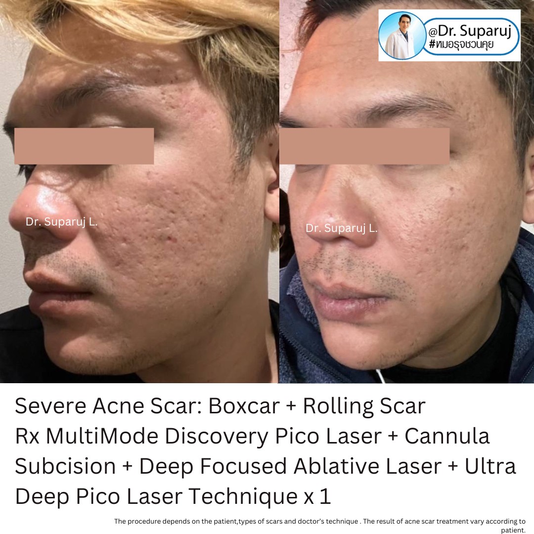 Update รักษาหลุมสิวด้วยเทคนิคการตัดพังผืด Blunt Blade Subcision (Blunt Blade Subcision for Acne Scar Fibrosis Treatment) Update รักษาหลุมสิวด้วยเทคนิคการตัดพังผืด Blunt Blade Subcision (Blunt Blade Subcision for Acne Scar Fibrosis Treatment)