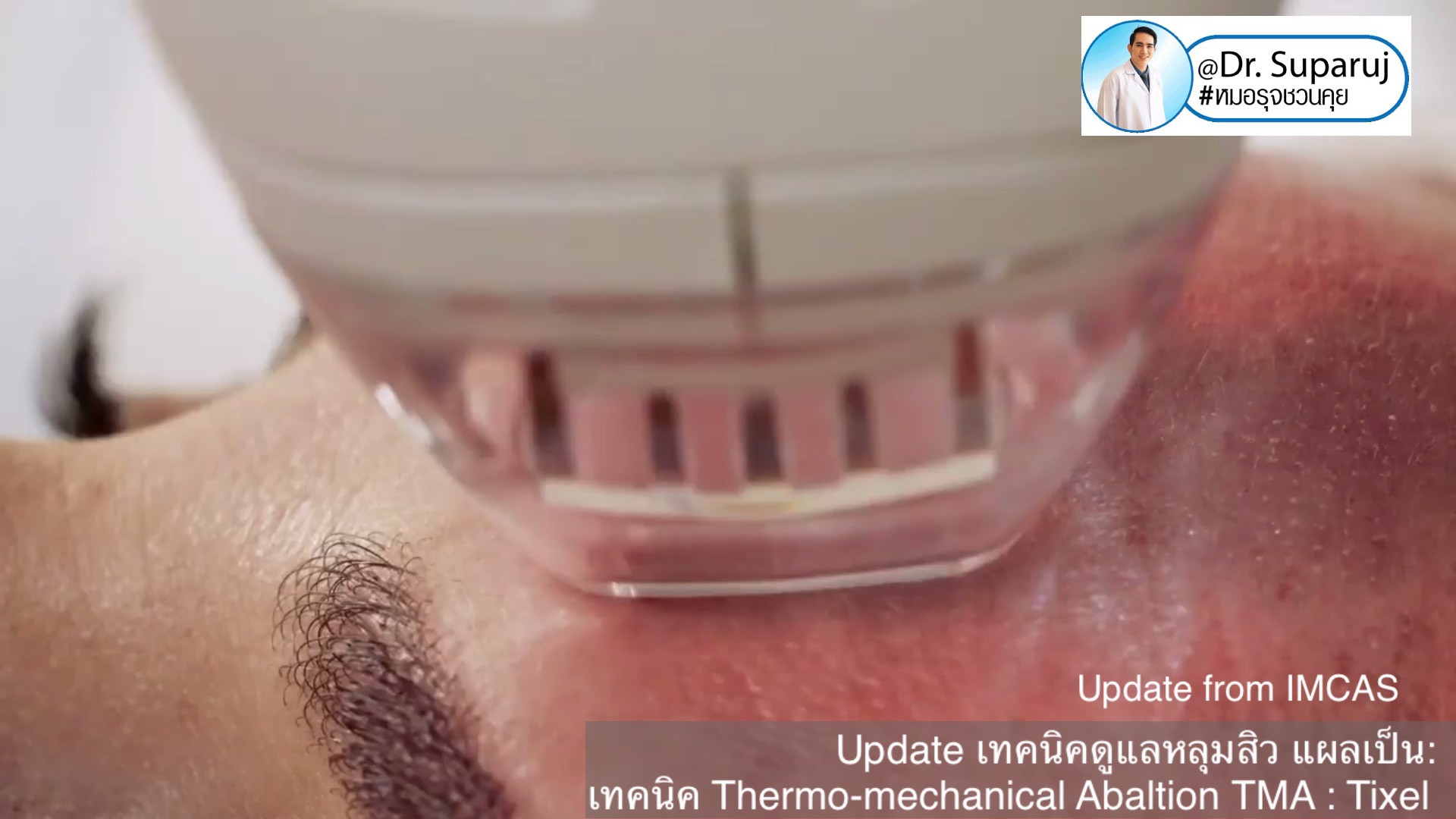 Update from IMCAS เทคนิครักษาหลุมสิว แผลเป็น ริ้วรอย: Tixel เทคนิค Thermo-mechanical Abaltion TMA