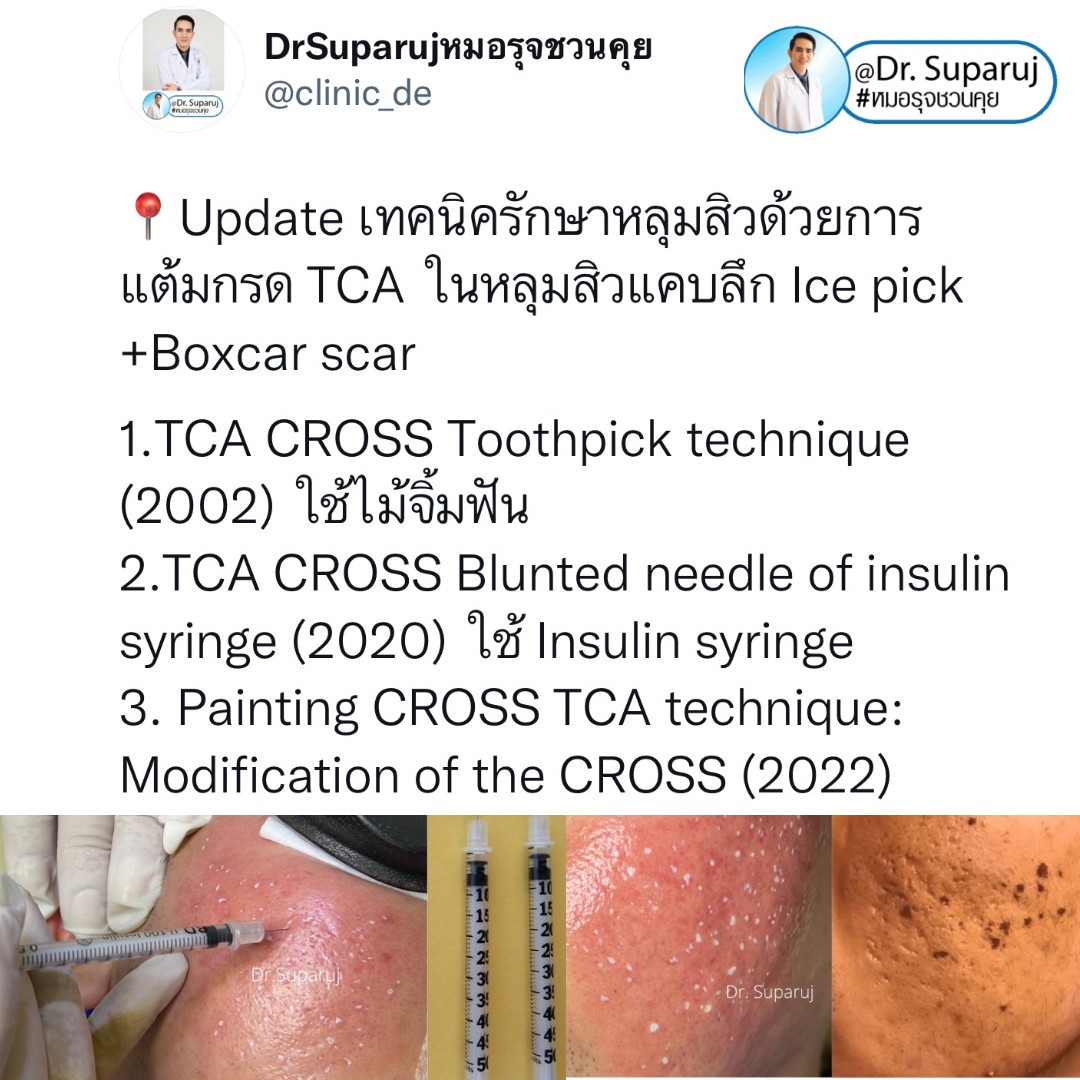 มีปัญหาหลุมสิว แต่ยังมีสิวขึ้นอยู่ สามารถรักษาหลุมสิวได้เลยไหม หรือควรดูแลอย่างไร? มีปัญหาหลุมสิว แต่ยังมีสิวขึ้นอยู่ สามารถรักษาหลุมสิวได้เลยไหม หรือควรดูแลอย่างไร?