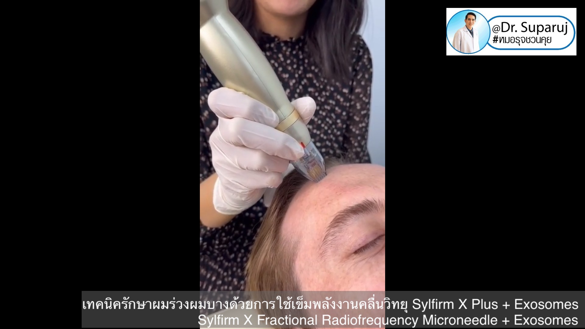 แนะนำเทคนิคดูแลผมร่วงผมบางด้วย Sylfirm X Fractional RF Microneedle + Exosomes for Hair Loss Treatment แนะนำเทคนิคดูแลผมร่วงผมบางด้วย Sylfirm X Fractional RF Microneedle + Exosomes for Hair Loss Treatment