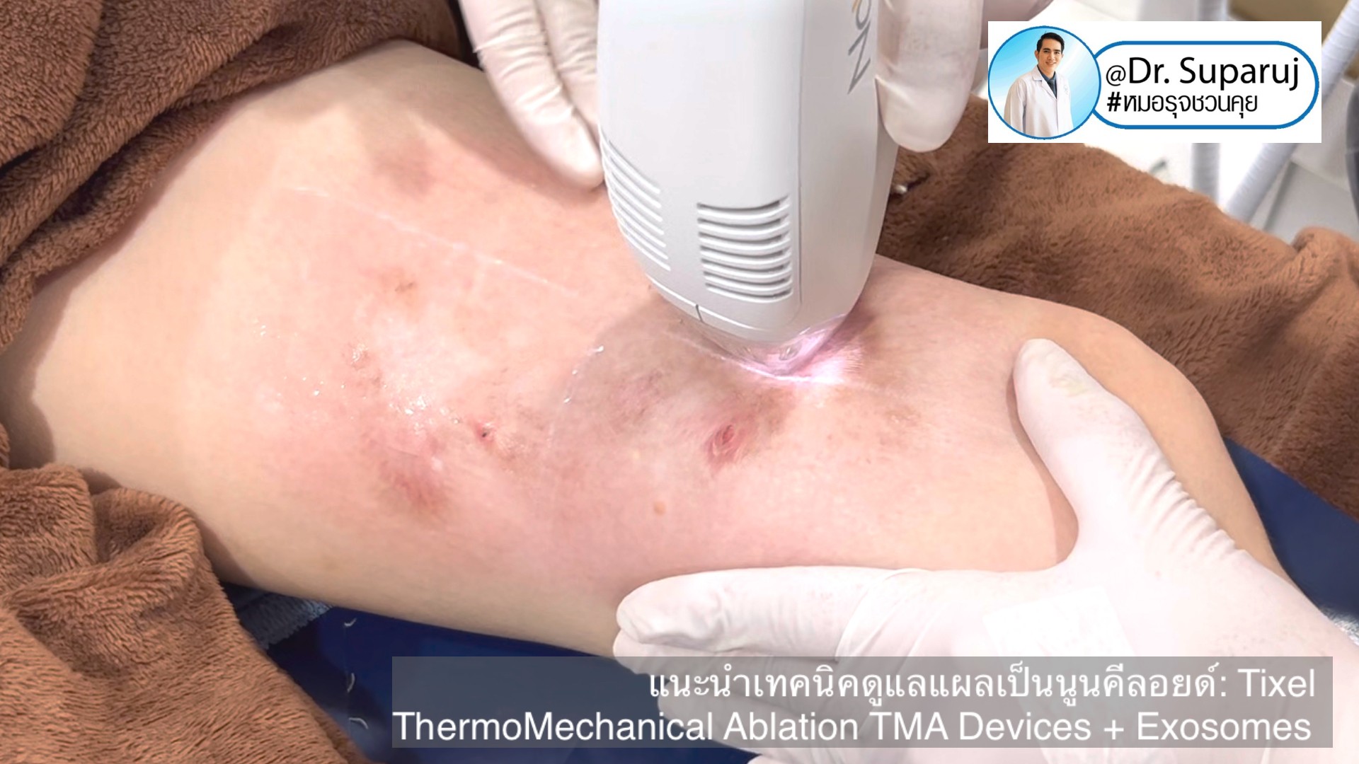 แนะนำเทคนิคดูแลแผลเป็นนูนคีลอยด์: รักษาแผลเป็นนูนด้วยทิกเซลล์ Tixel Fractional ThermoMechanical Ablation Devices + Exosomes แนะนำเทคนิคดูแลแผลเป็นนูนคีลอยด์: รักษาแผลเป็นนูนด้วยทิกเซลล์ Tixel Fractional ThermoMechanical Ablation Devices + Exosomes
