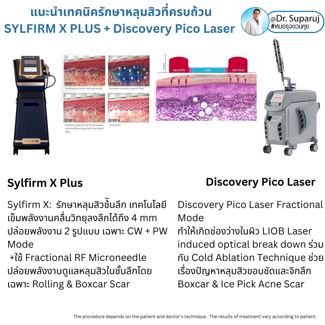 แนะนำเทคนิคดูแลรักษาหลุมสิว: เทคนิครักษาหลุมสิวด้วย 2 เทคนิคเสริมประสิทธิภาพ SYLFIRM X Plus + Discovery Pico Laser Combination Treatment