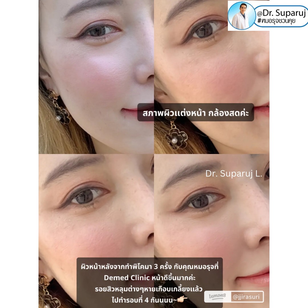 รีวิวรักษาหลุมสิวด้วย Pico Laser +Exosome มันเริดมากแม๊ รีวิวรักษาหลุมสิวด้วย Pico Laser +Exosome มันเริดมากแม๊