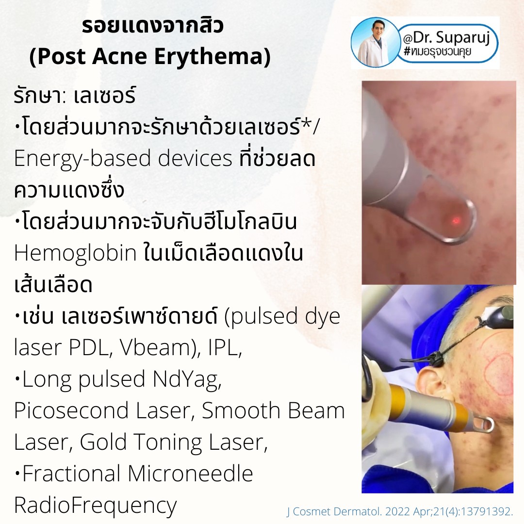 แชร์ประสบการณ์ Discovery Pico Laser พลีชีพความจริง