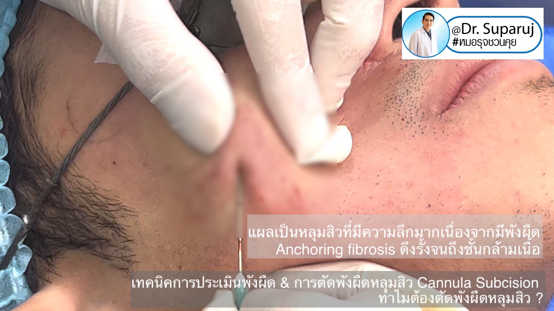 เทคนิคการประเมินพังผืด และการตัดพังผืดหลุมสิว Cannula Subcision ทำไมต้องตัดพังผืดรักษาหลุมสิว ?(Acne Scar Fibrosis Evaluation & Cannula Subcision Treatment) 